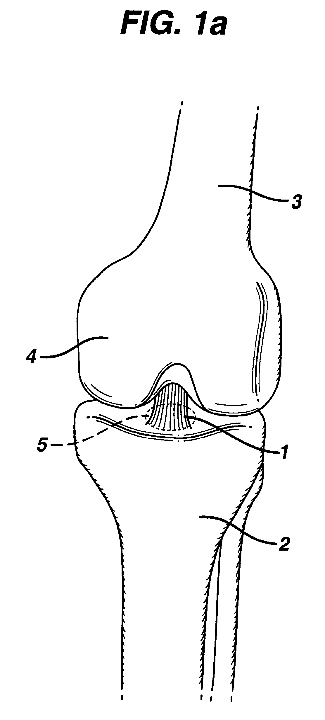 Method for anchoring autologous or artificial tendon grafts in bone