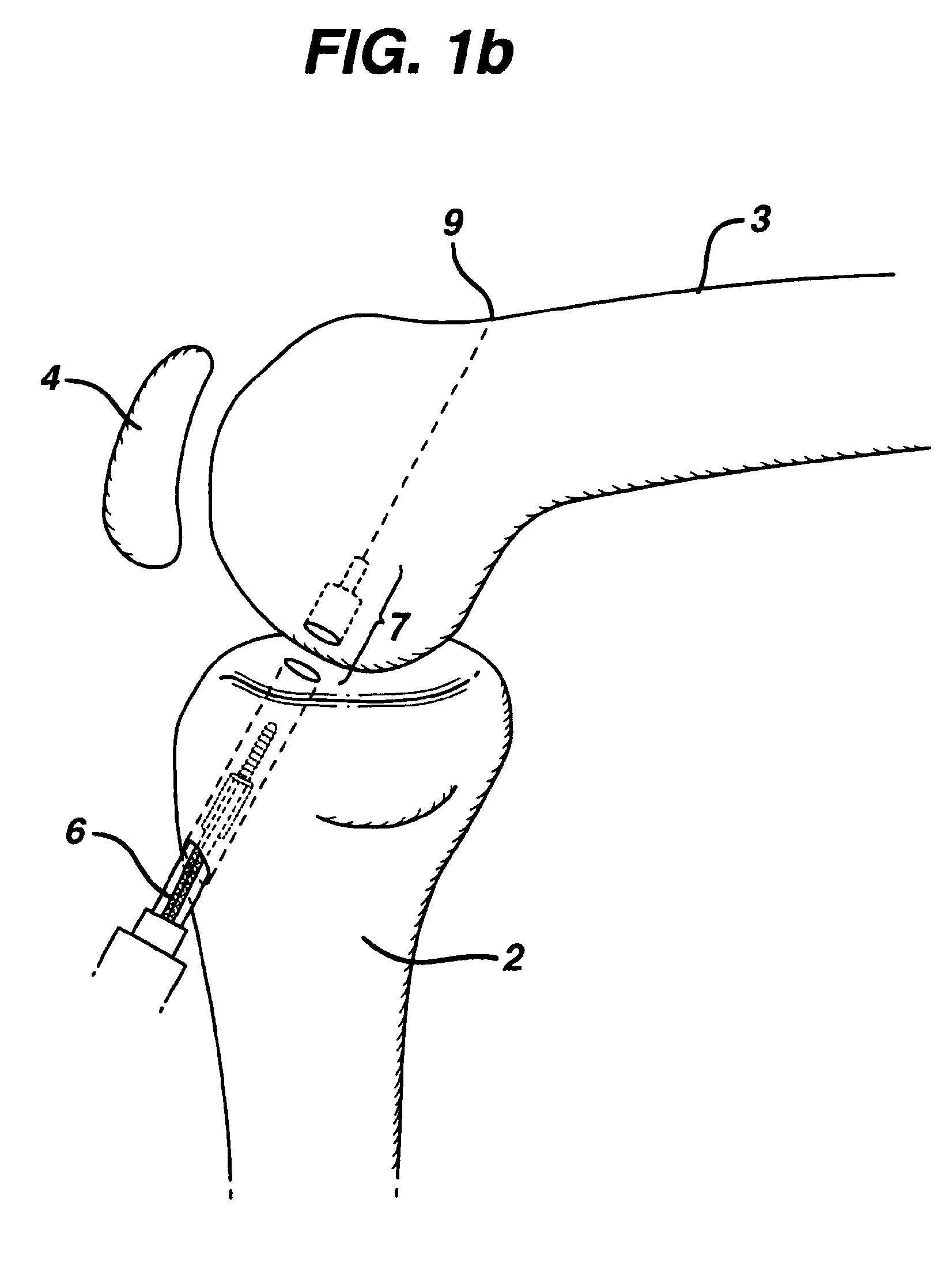 Method for anchoring autologous or artificial tendon grafts in bone