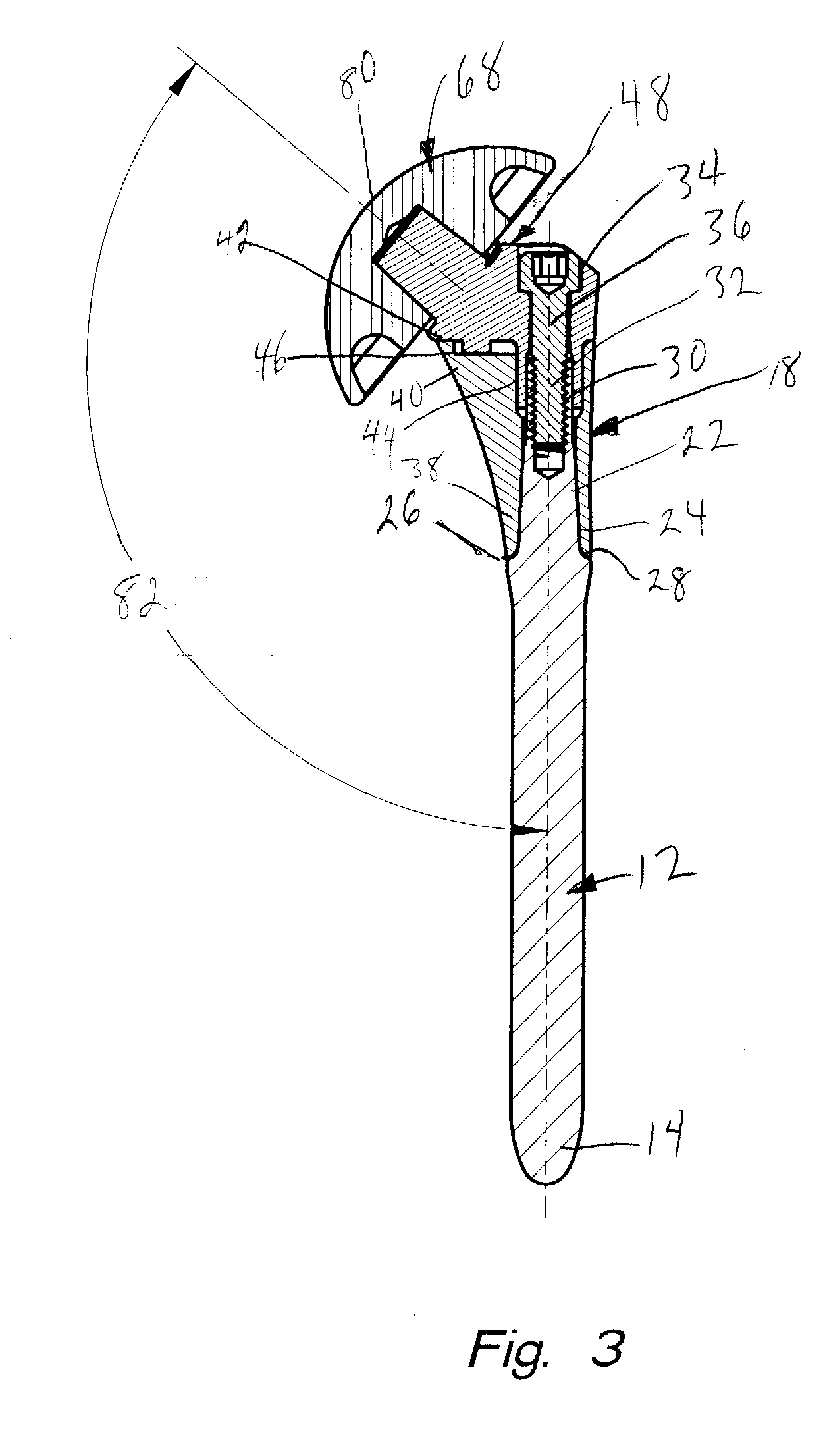 Modular shoulder prosthesis with load bearing surface