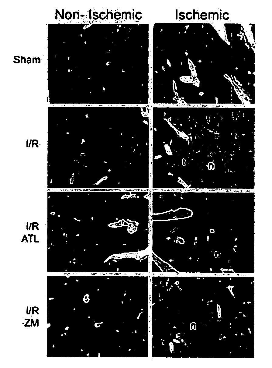 Agonists of a2a adenosine receptors for treating recurrent tumor growth in the liver following resection