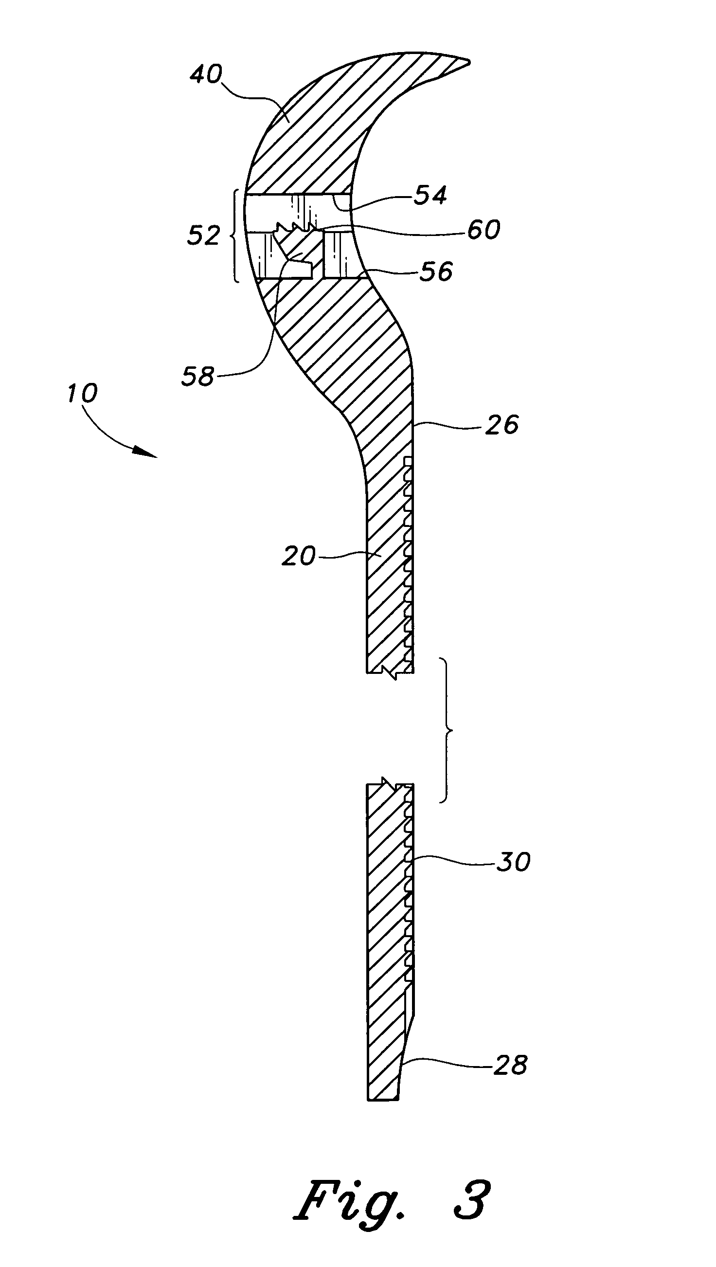 Bio-absorbable bone tie with convex head