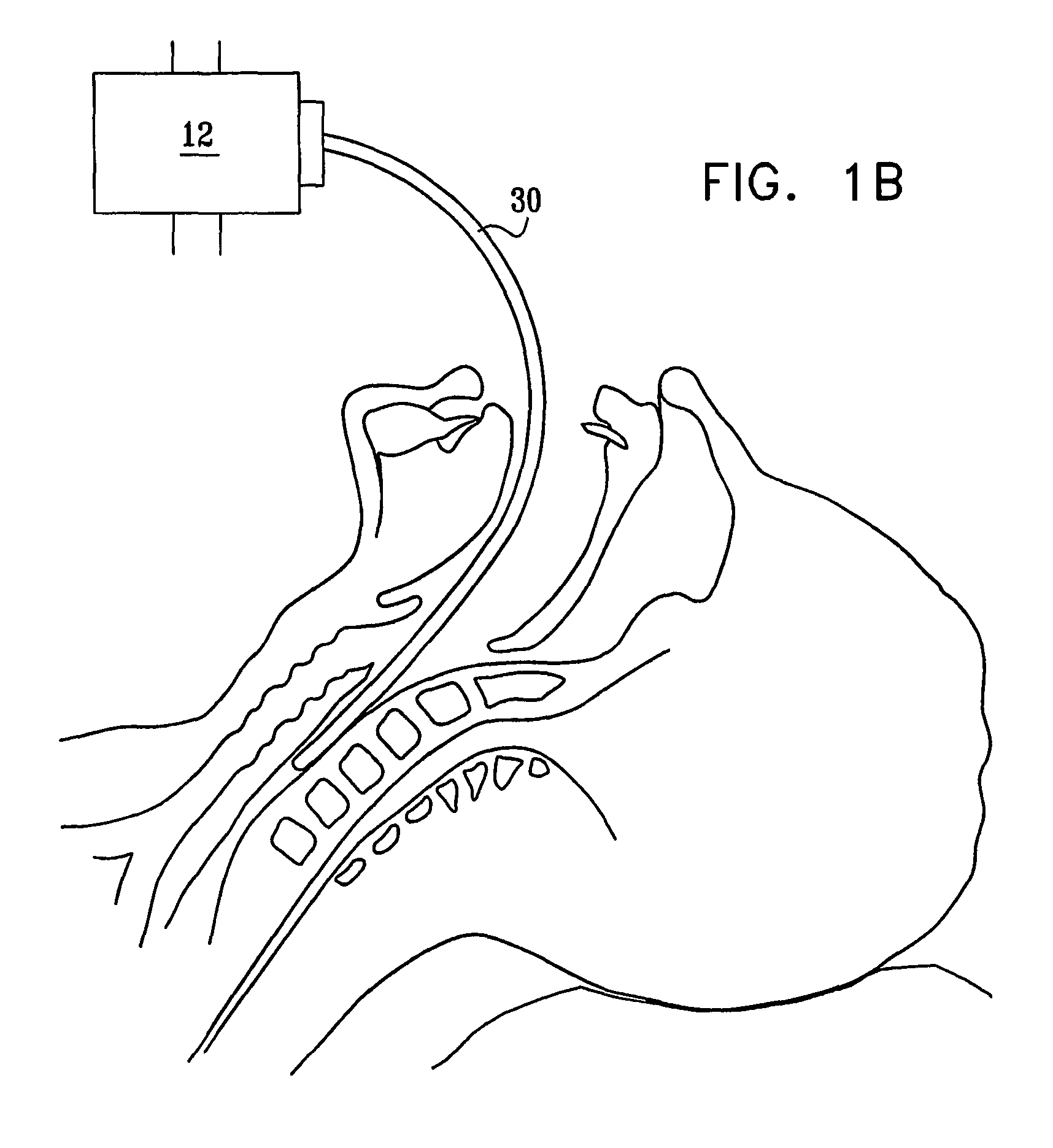 Characterization of arteriosclerosis by optical imaging