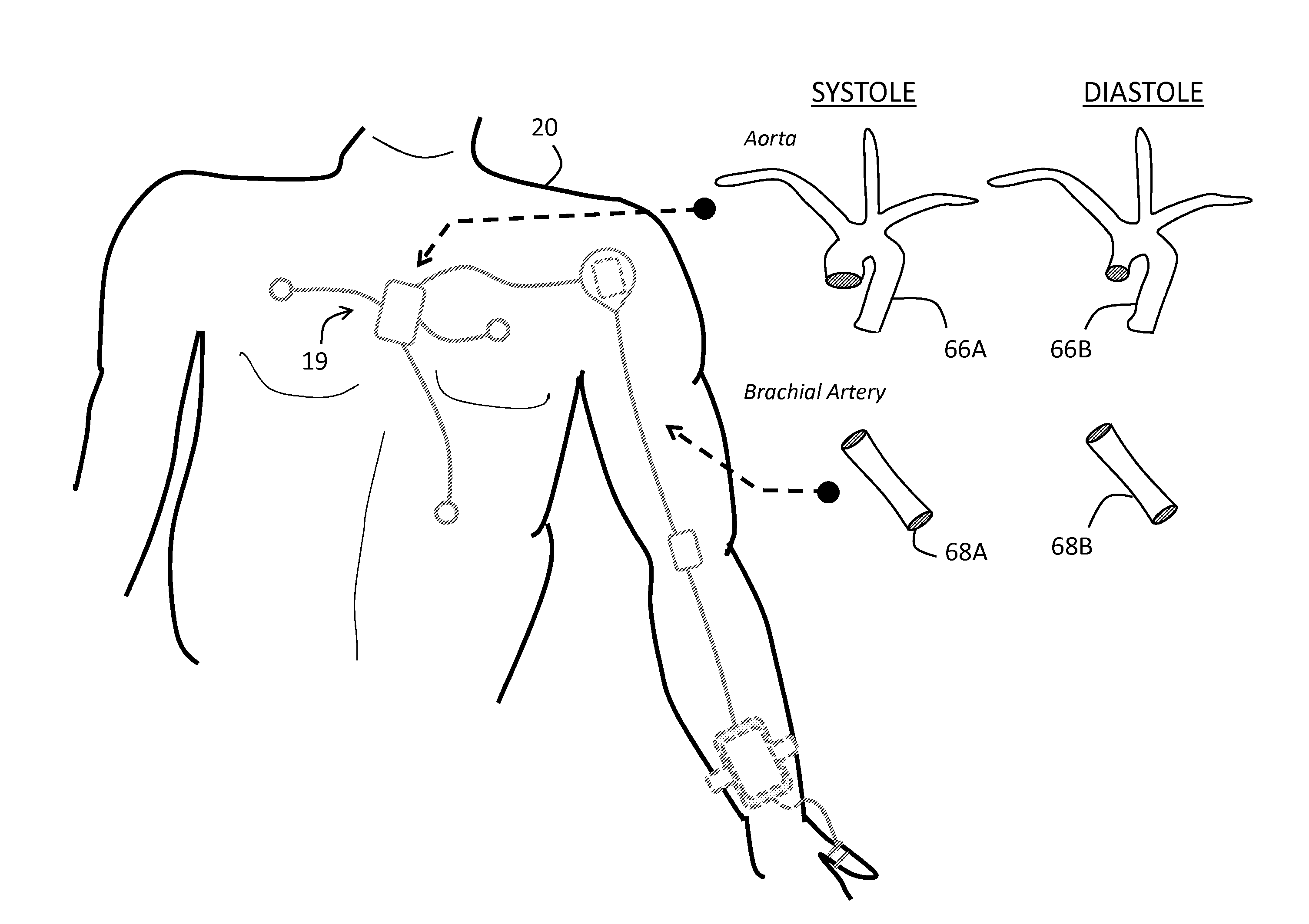 Body-worn system for continuous, noninvasive measurement of cardiac output, stroke volume, cardiac power, and blood pressure