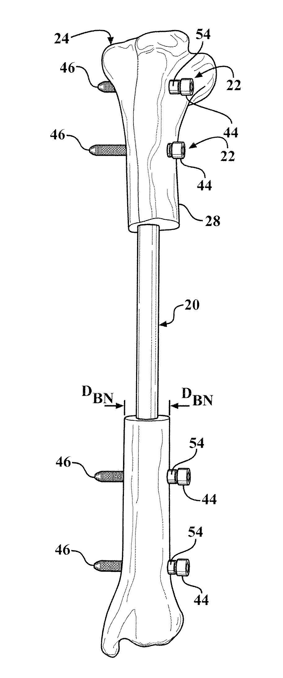 Easily Implantable And Stable Nail-Fastener For Skeletal Fixation And Method