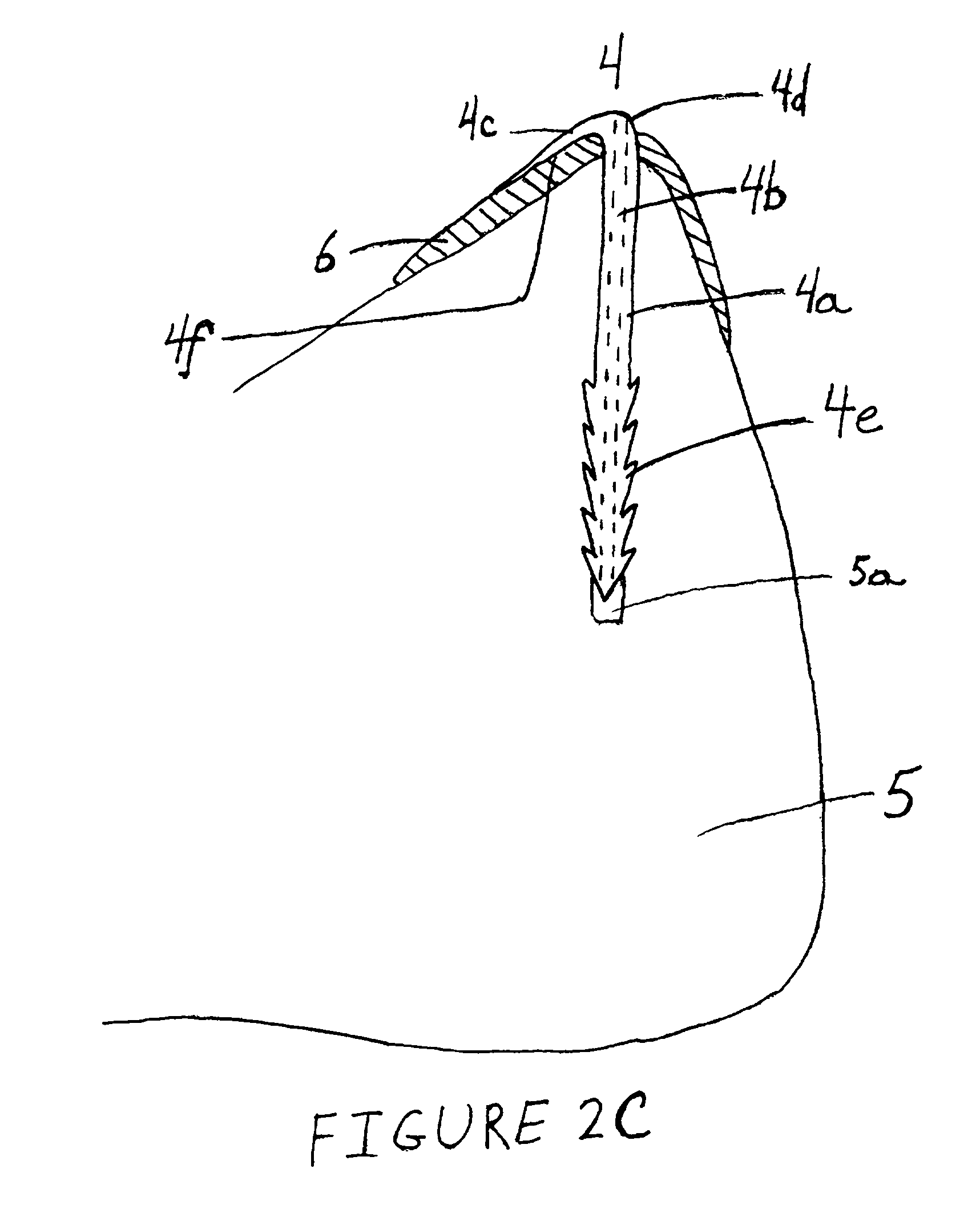 Anatomical fixation implant