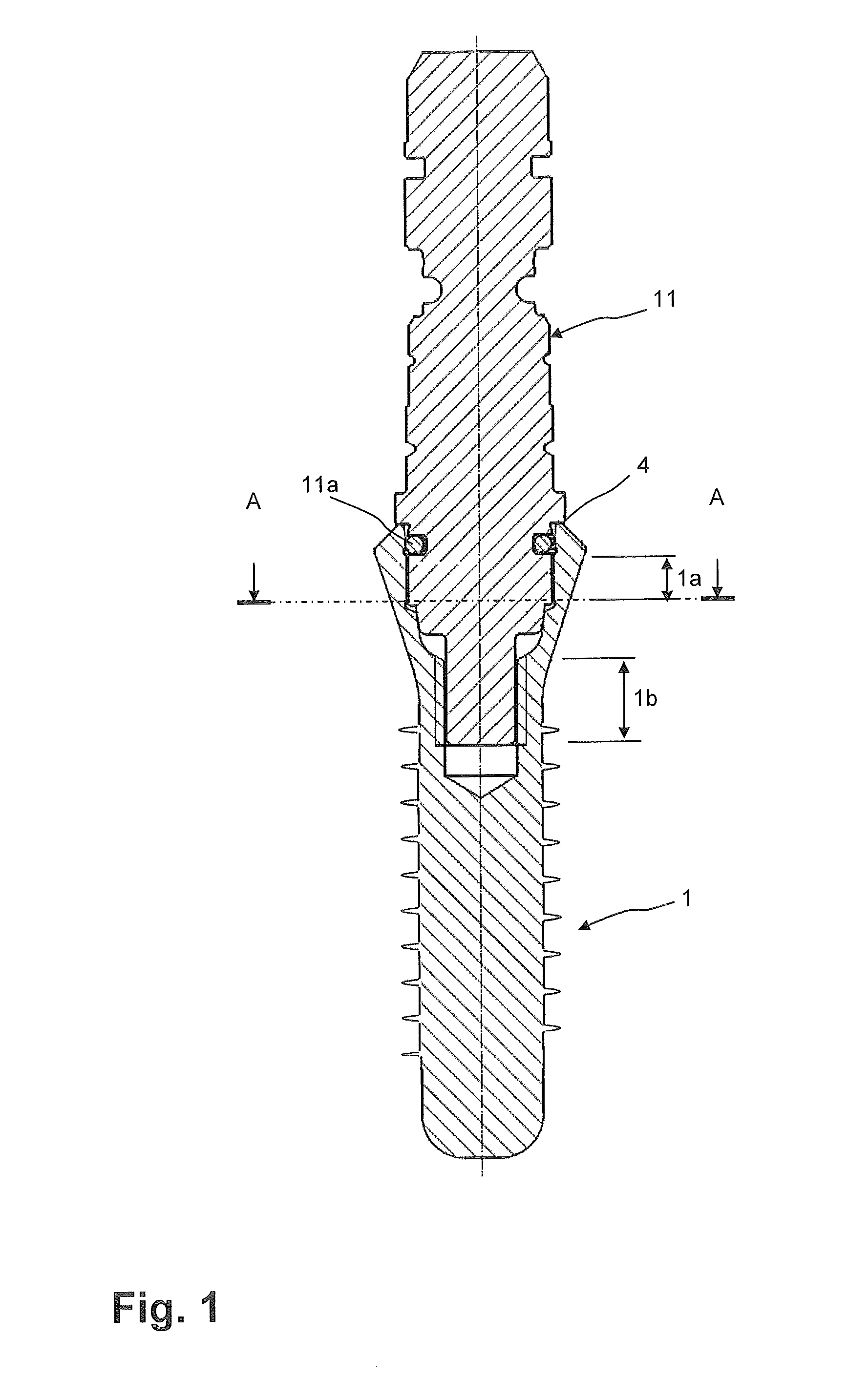 Dental implant socket arrangement