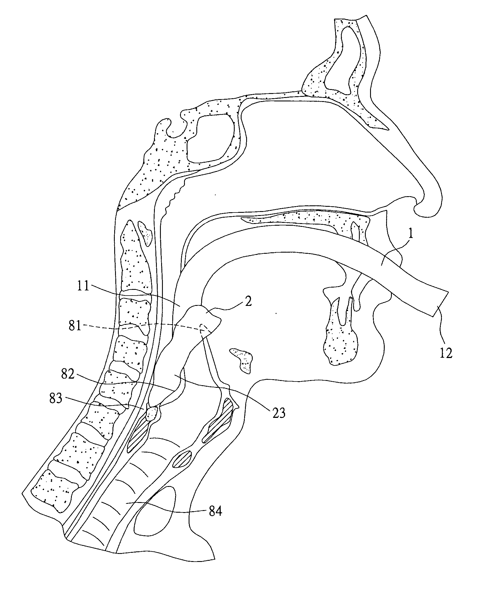 Anatomically hypopharyngeal mask