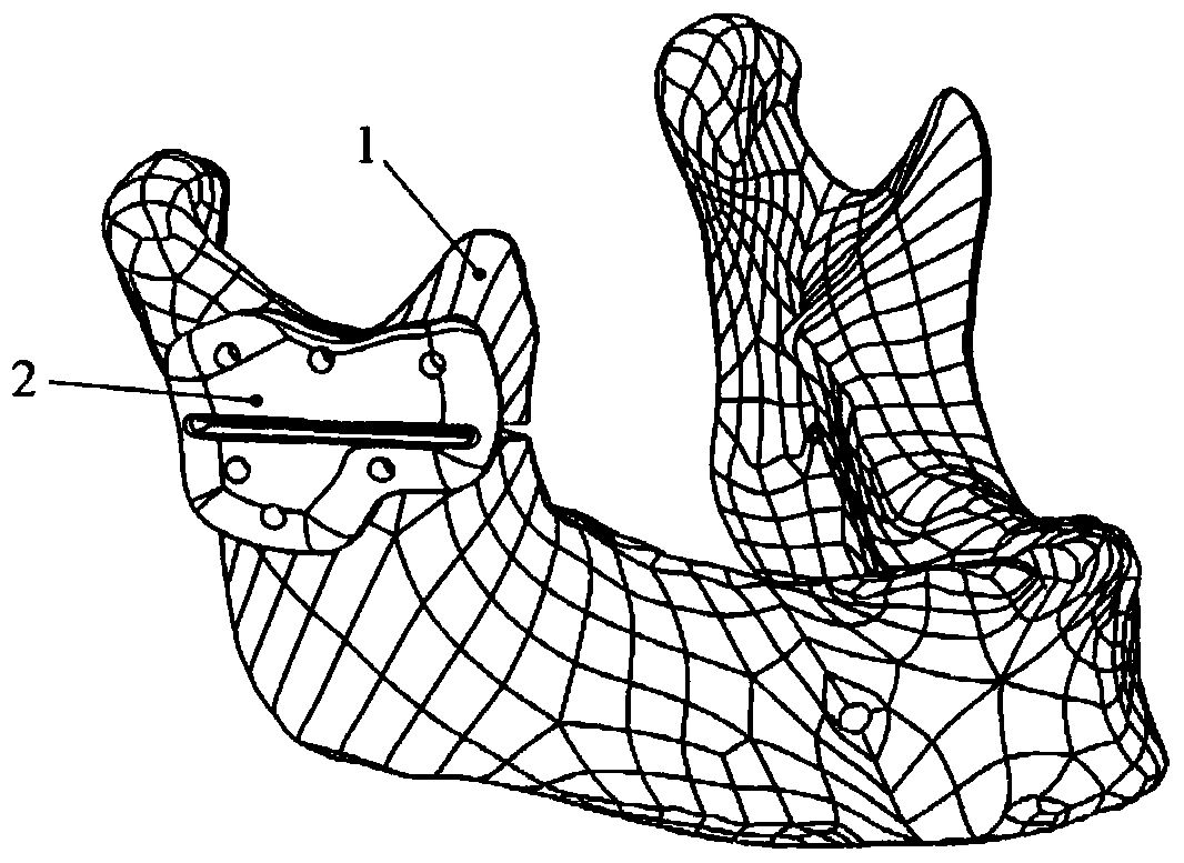 Personalized jaw surgery guide and manufacturing method thereof