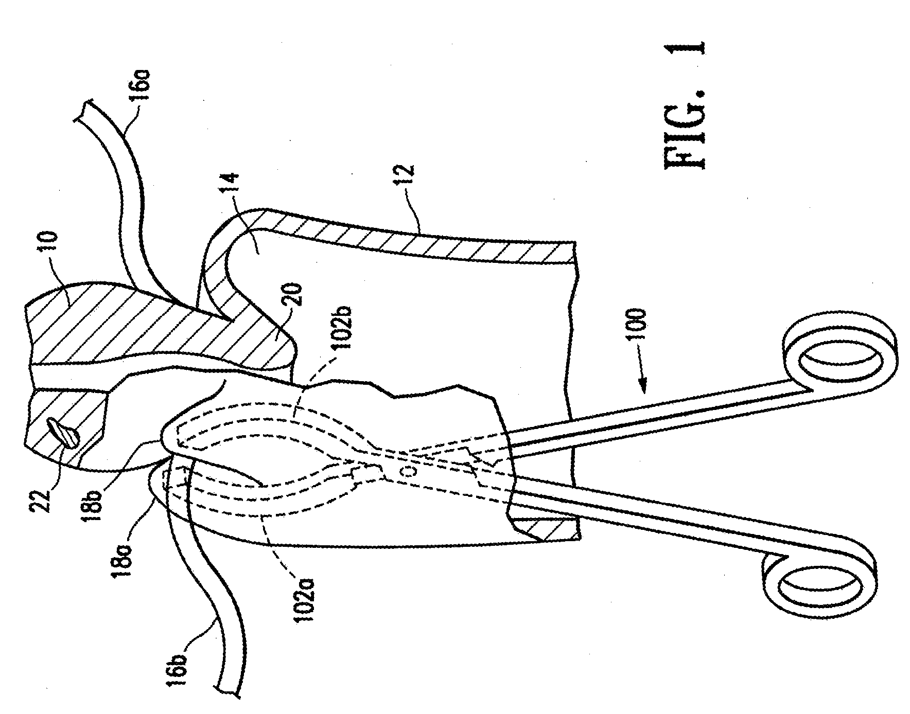 Methods for minimally invasive, non-permanent occlusion of a uterine artery