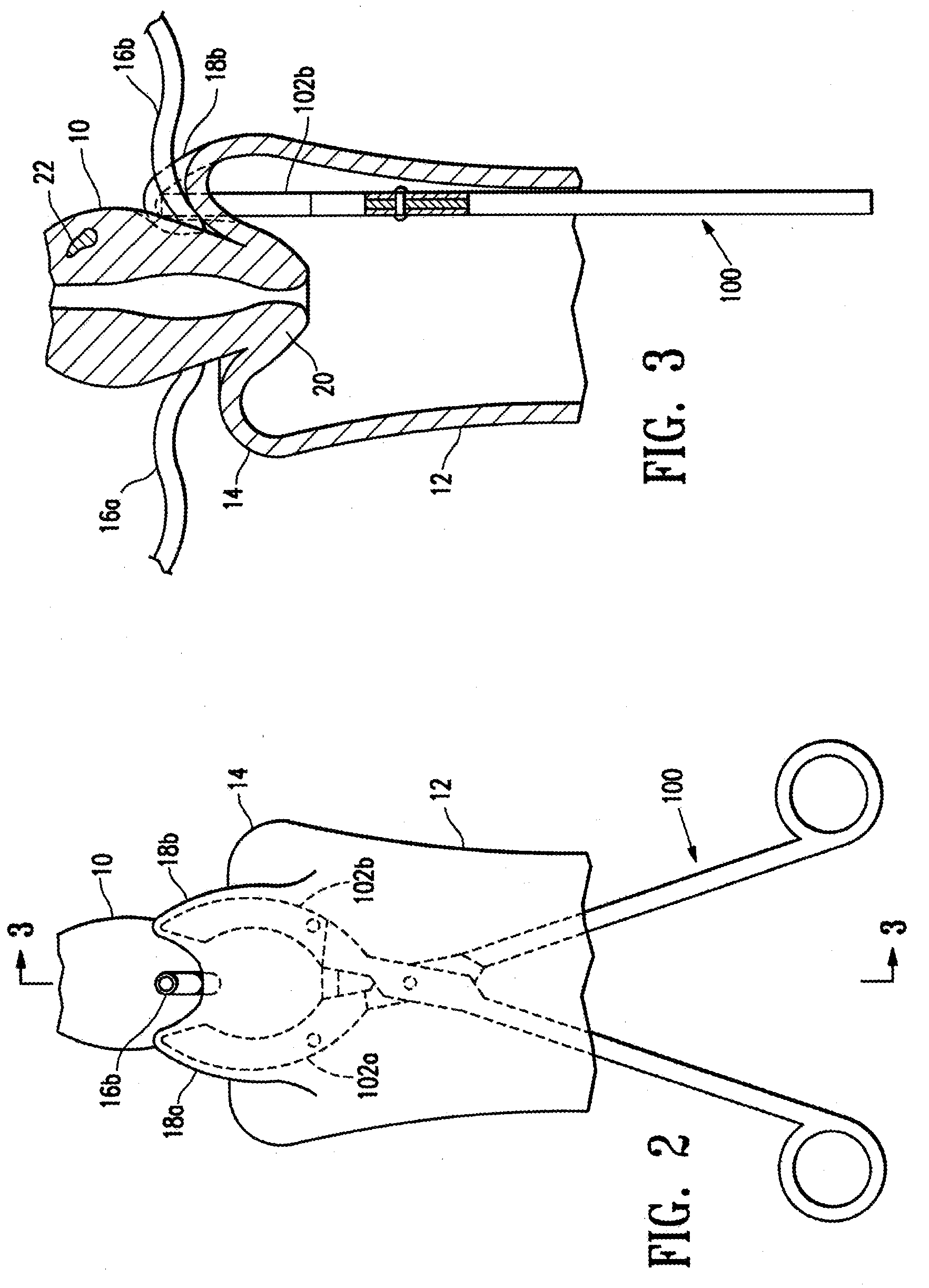 Methods for minimally invasive, non-permanent occlusion of a uterine artery