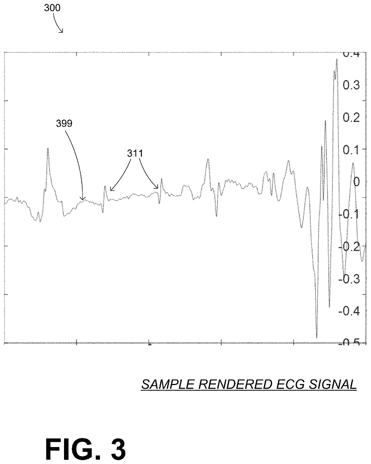 Wearable cardioverter defibrillator (WCD) system detecting QRS complexes in ECG signal by matched difference filter