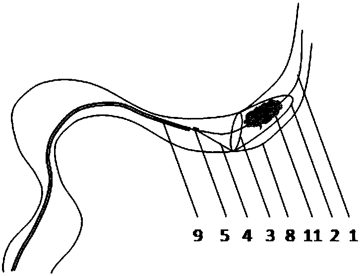 Intra-cerebrovascular special thrombus extraction apparatus