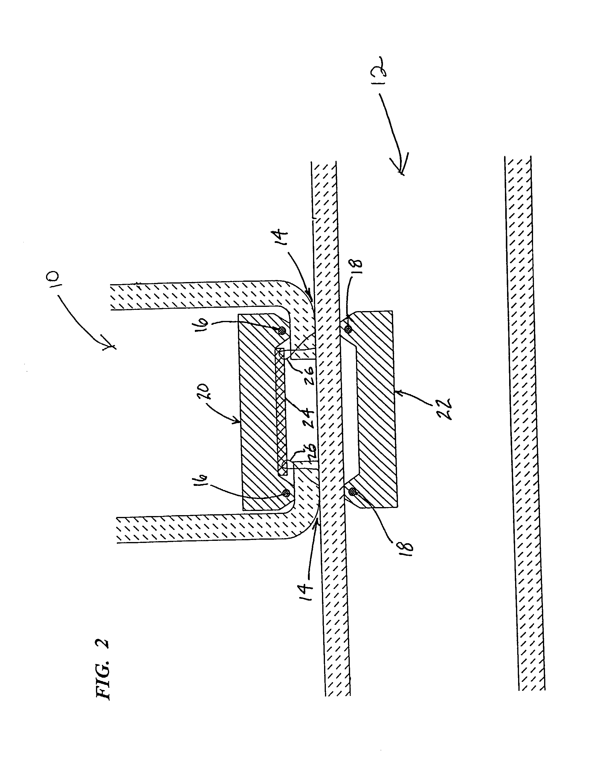 Anastomosis system and related Methods