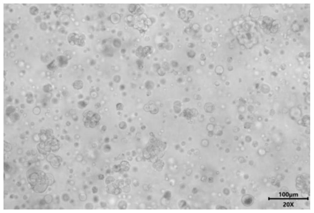 Special culture medium for lung cancer organoid and culture method