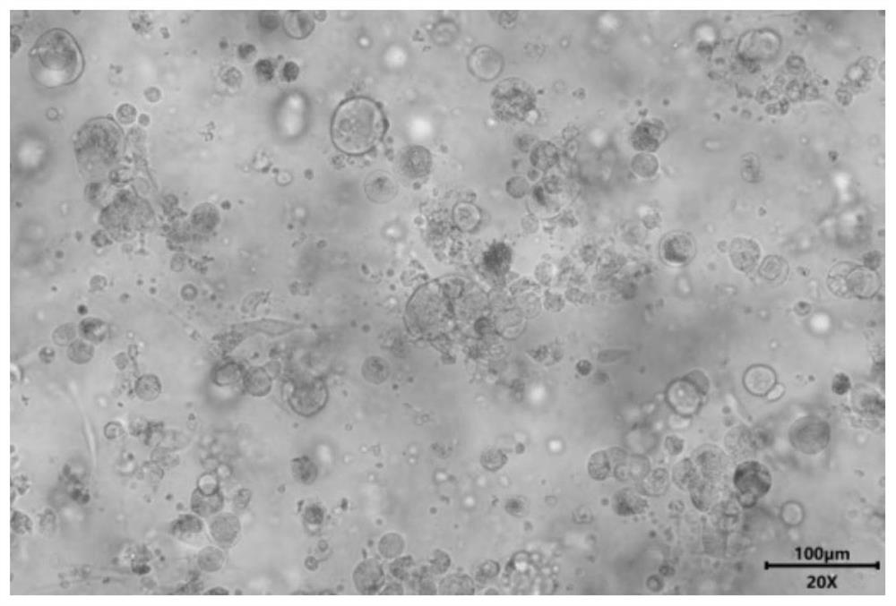 Special culture medium for lung cancer organoid and culture method