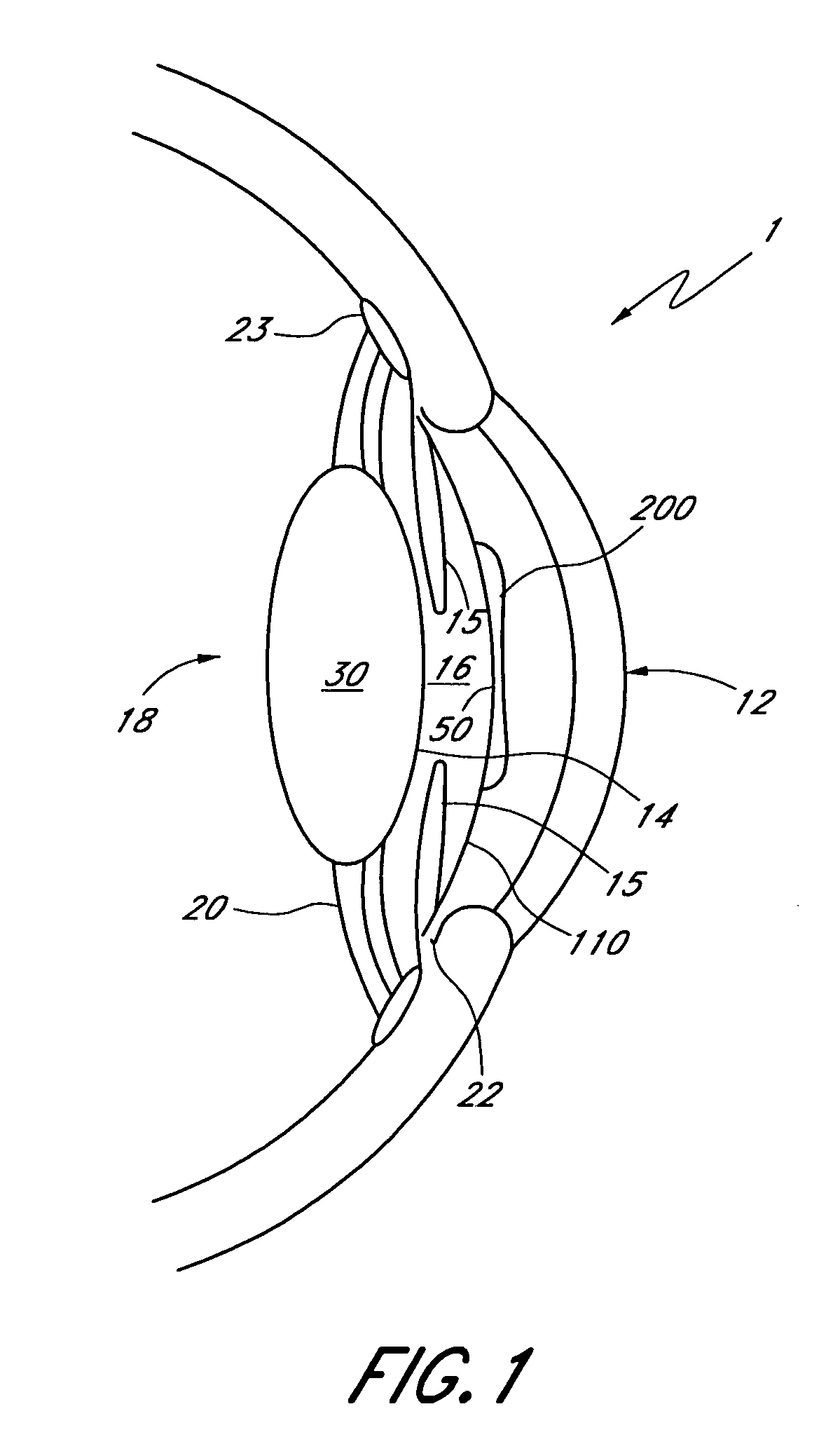 Two part "L"-shaped phakic IOL