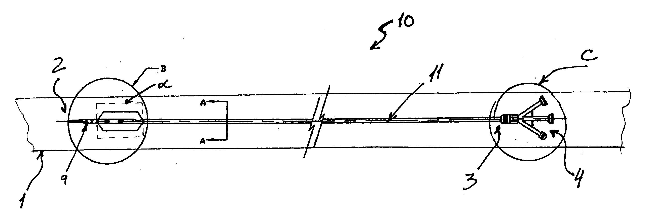 Percutaneously retrievable stent assembly with fluid draining capability