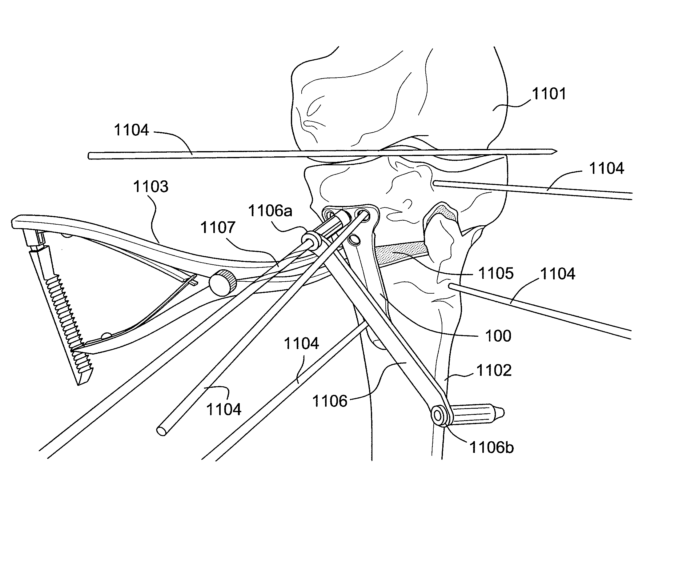 Carbon fiber reinforced peek bone plate with titanium fixation screws