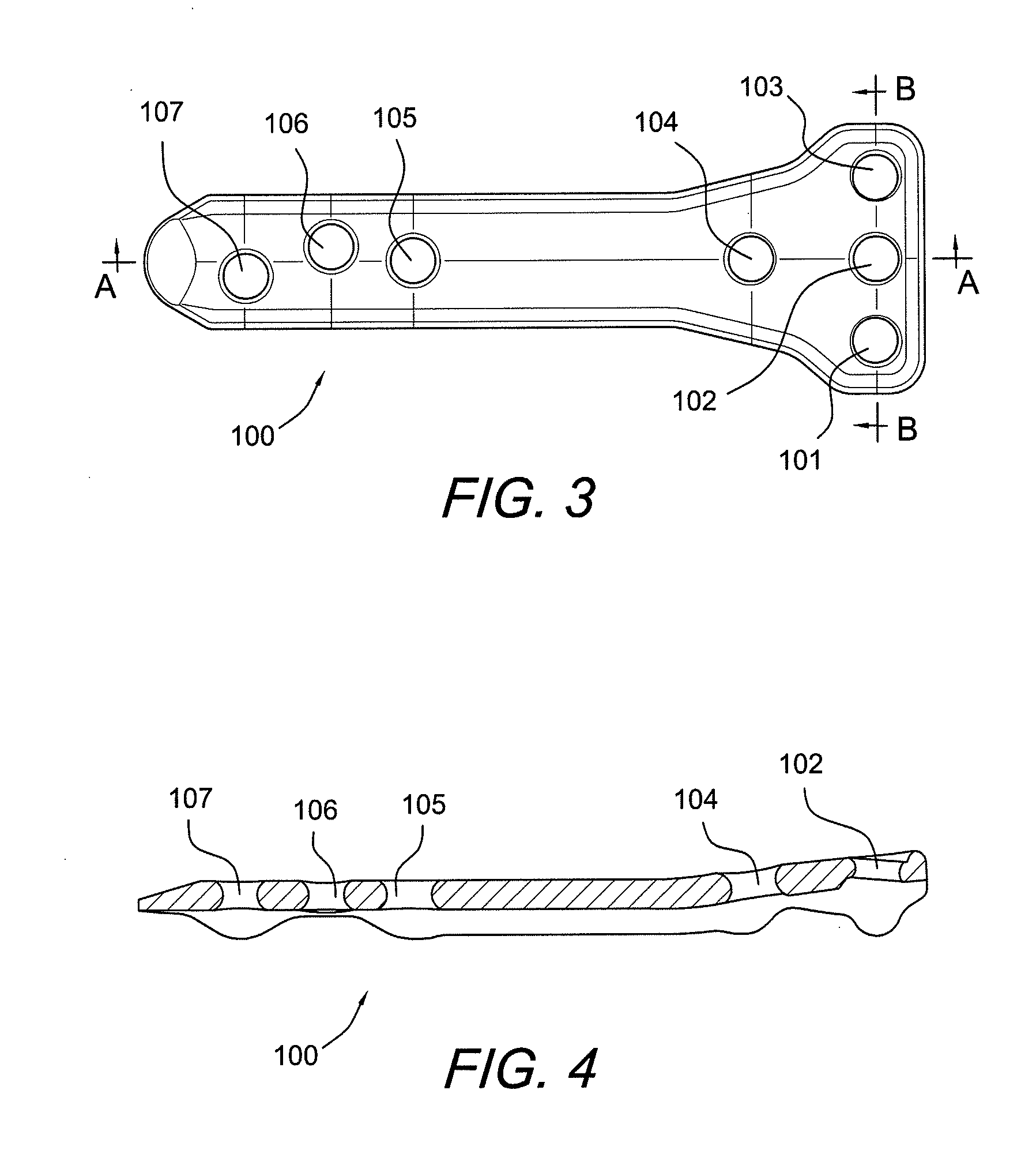 Carbon fiber reinforced peek bone plate with titanium fixation screws