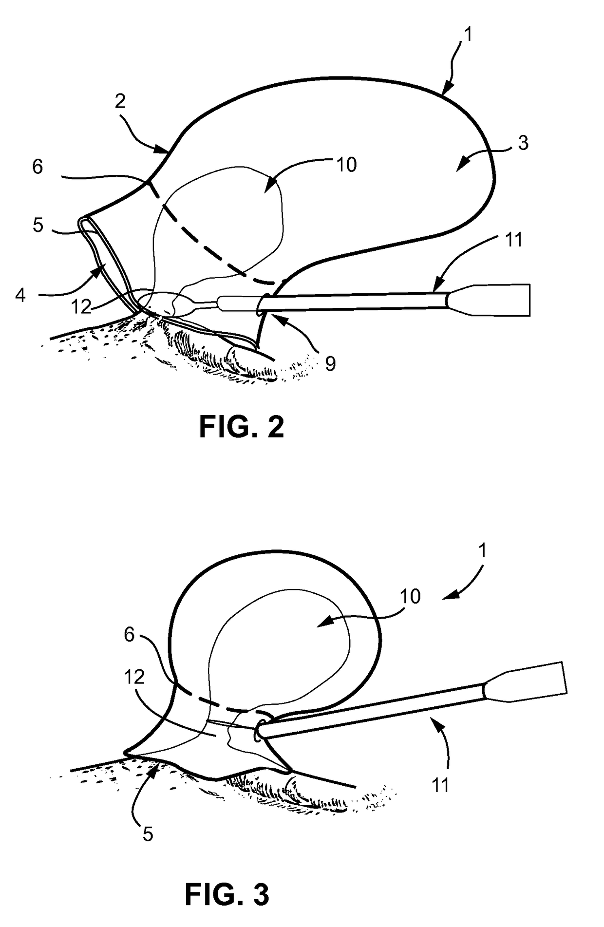 Method of amputating and morcellating a uterus