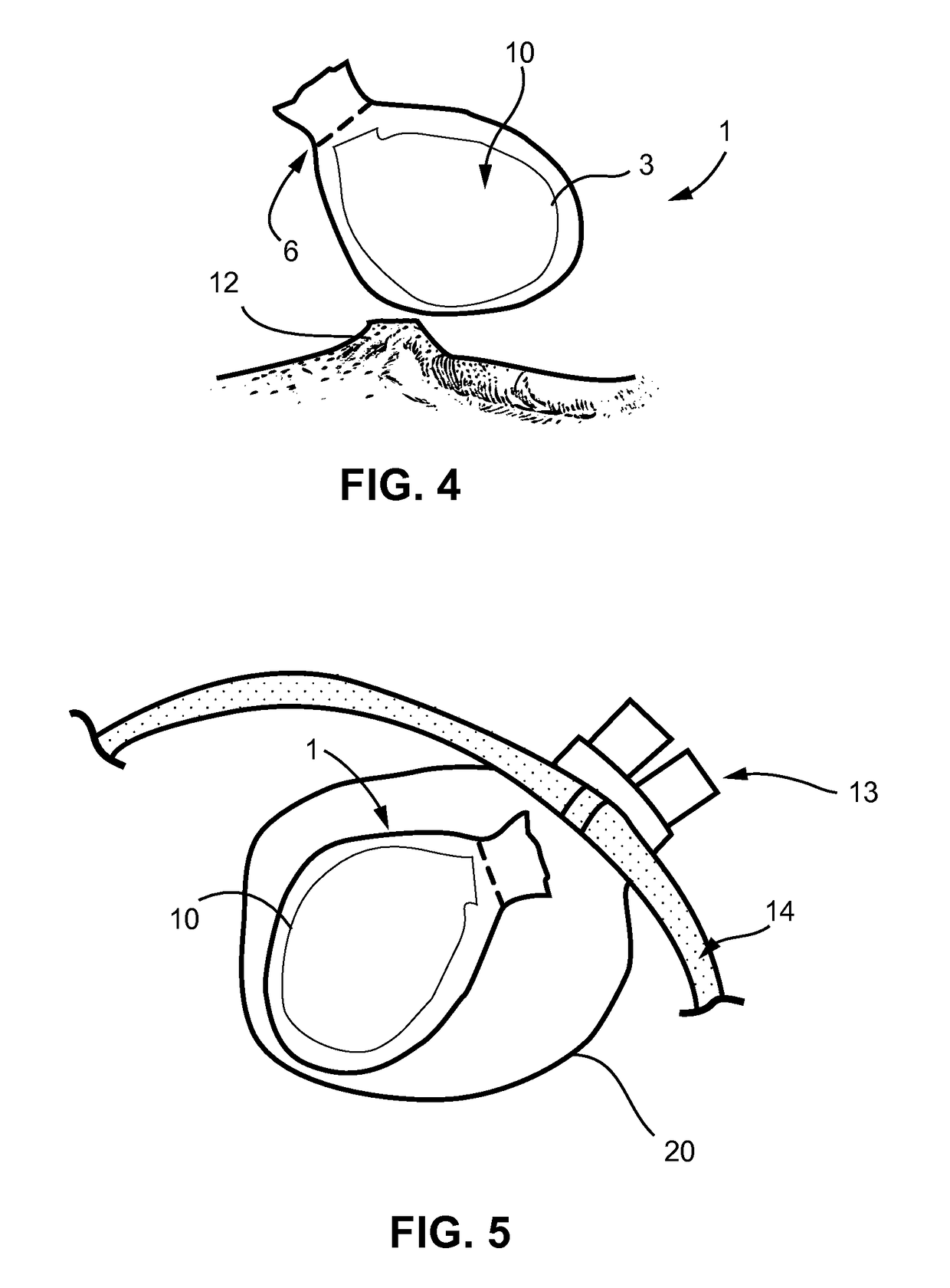 Method of amputating and morcellating a uterus