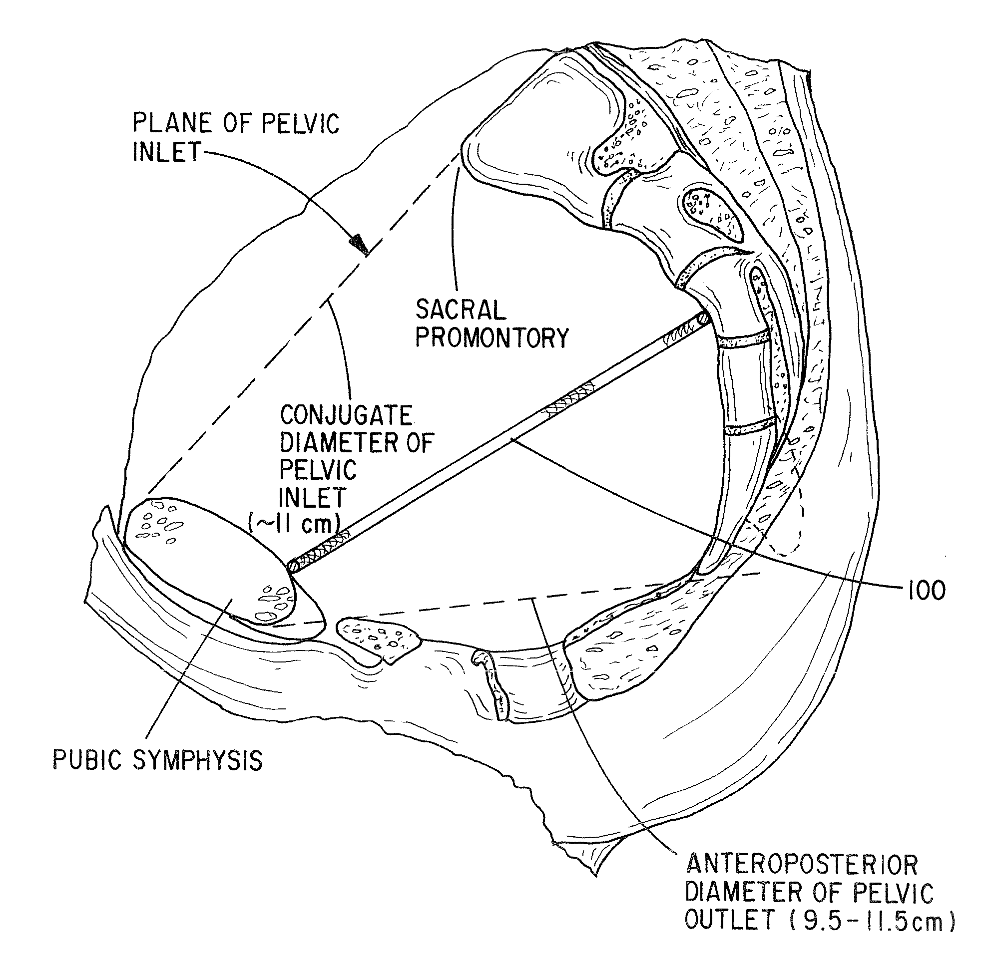 Apparatus and method for pelvic floor repair in the human female