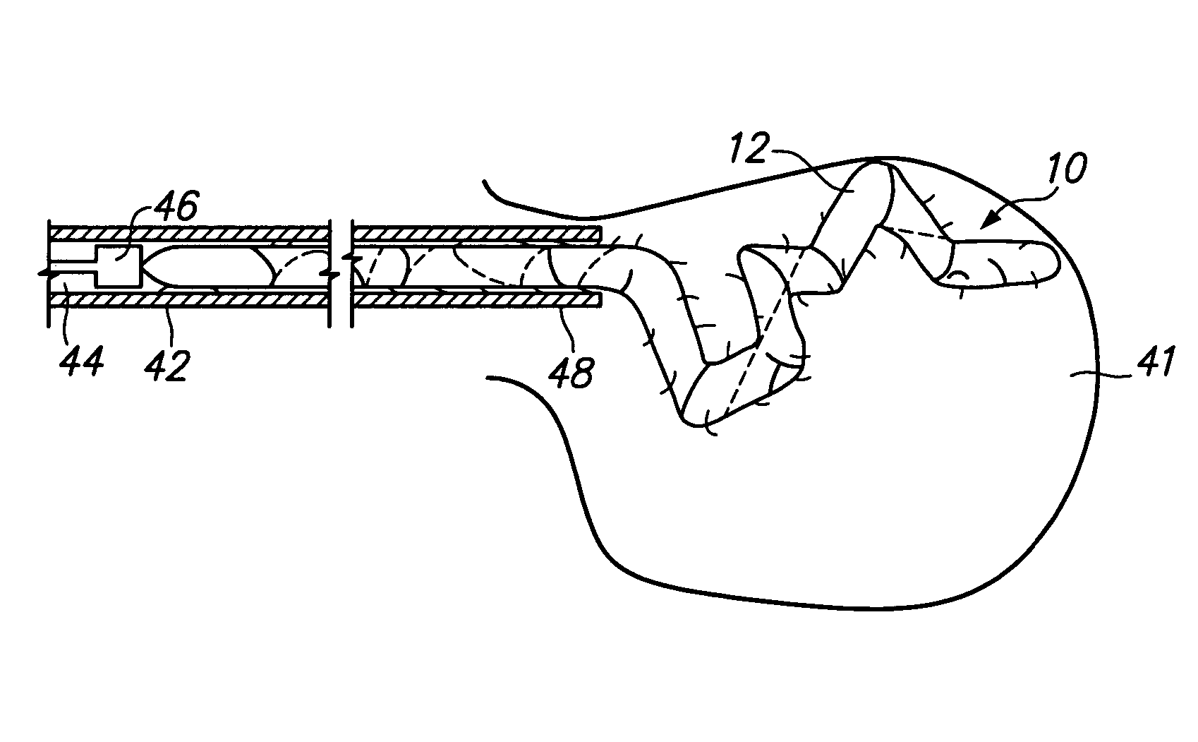 Systems and methods of de-endothelialization