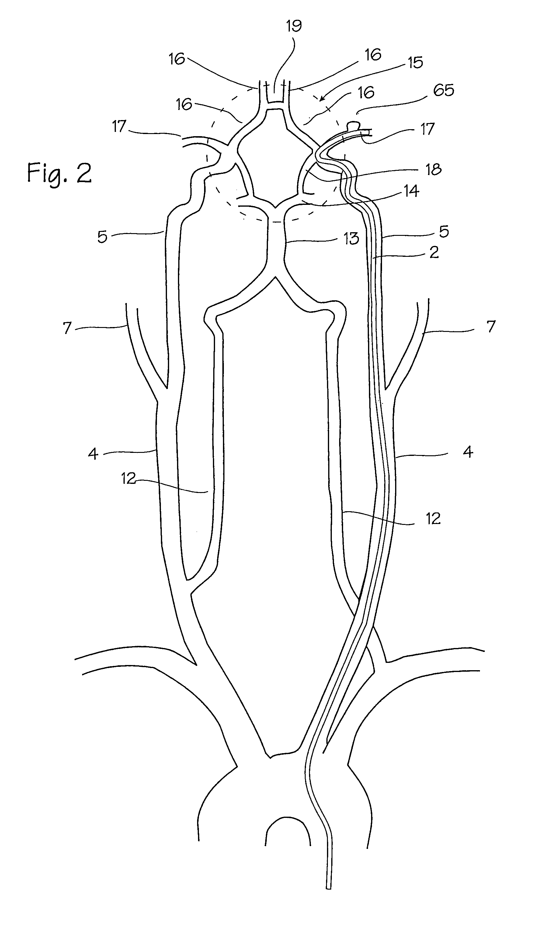 Intracranial stent and method of use