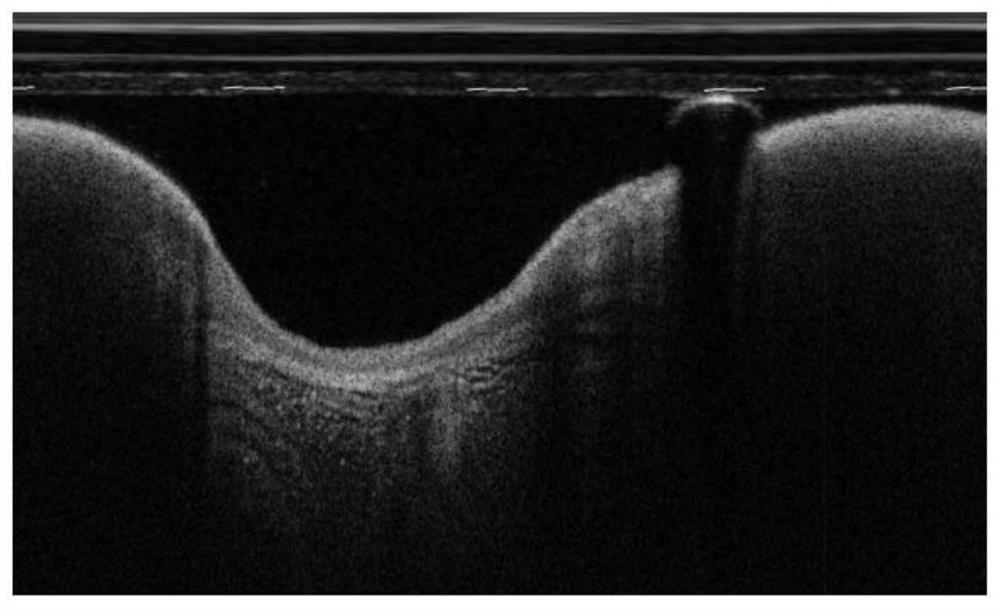 A method and device for automatic detection of thin fibrous cap plaques based on cardiovascular OCT images