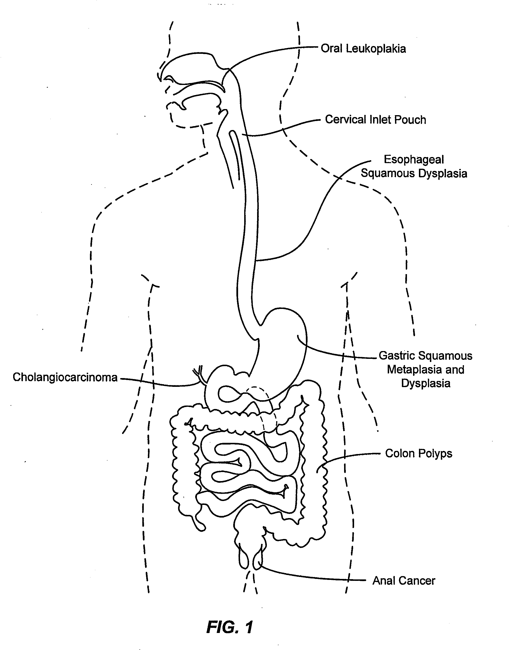 Method and Apparatus for Ablation of Benign, Pre-Cancerous and Early Cancerous Lesions That Originate Within the Epithelium and are Limited to the Mucosal Layer of the Gastrointestinal Tract