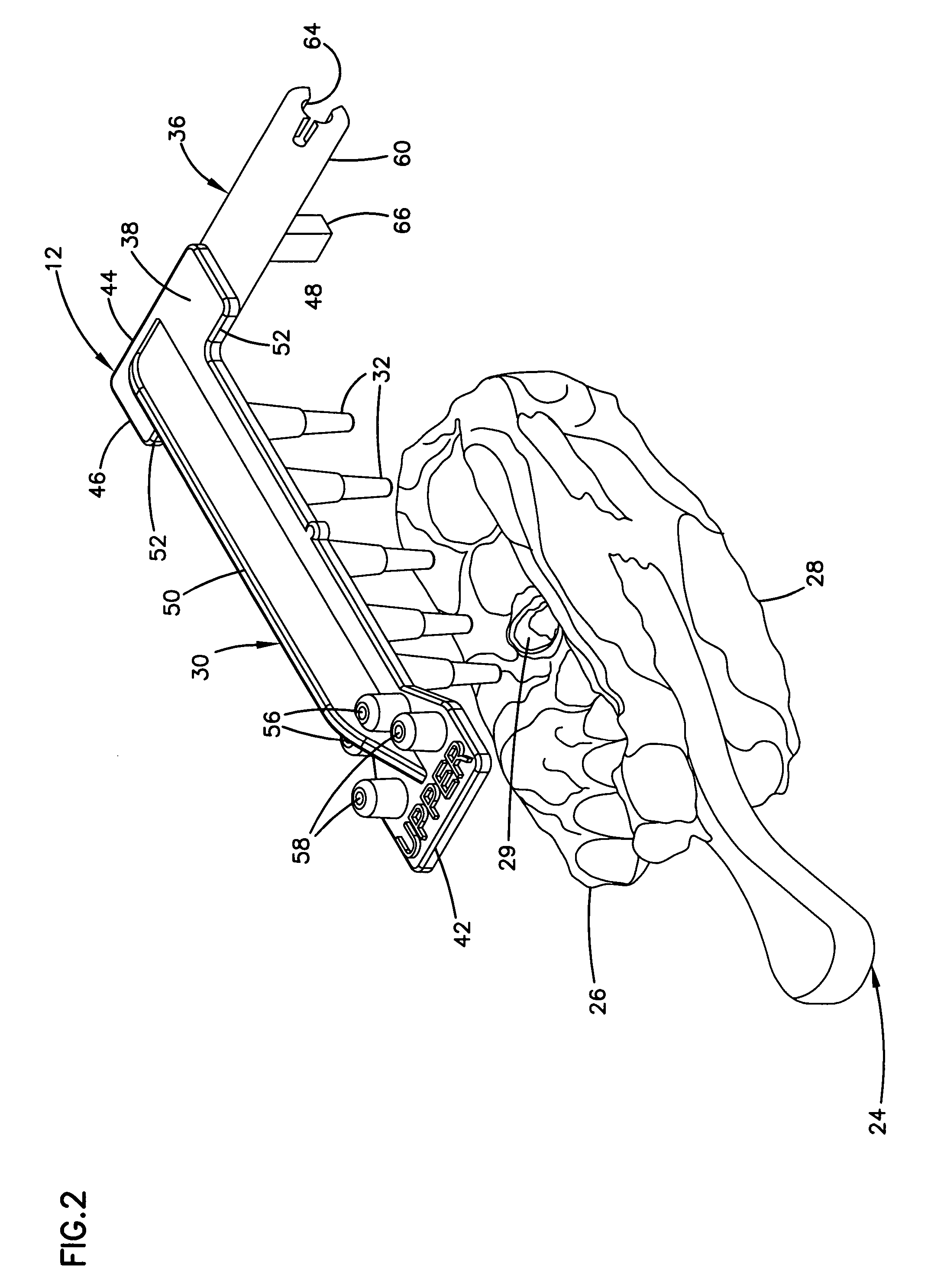 Dental articulator