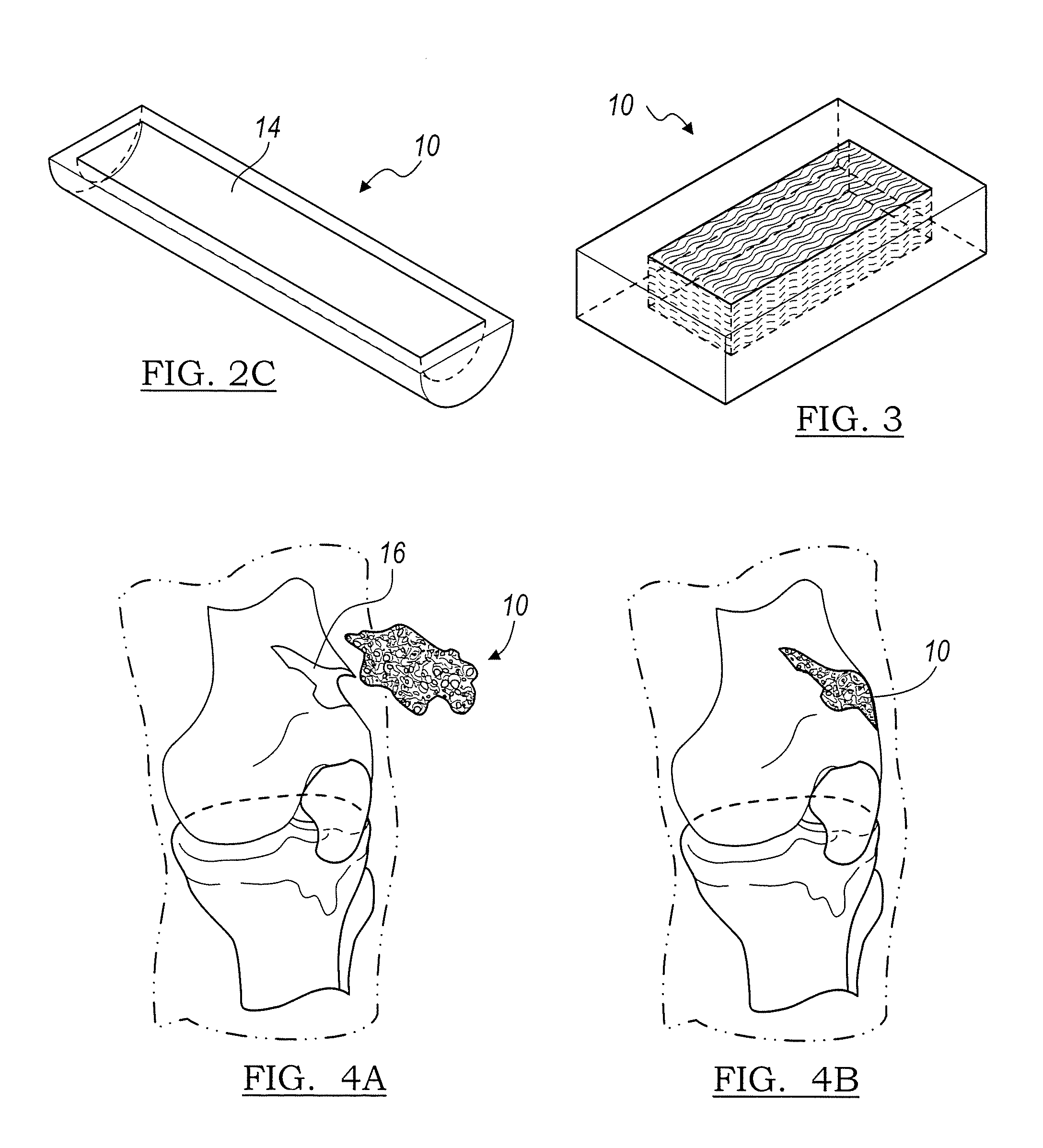 Resorbable bone graft materials