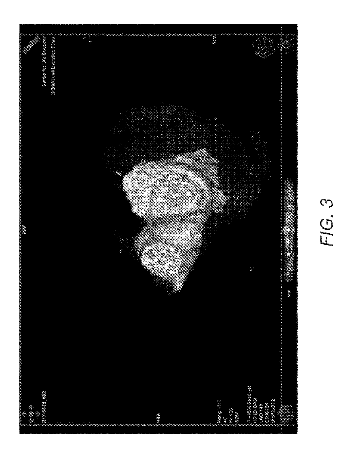 Naturally designed mitral prosthesis