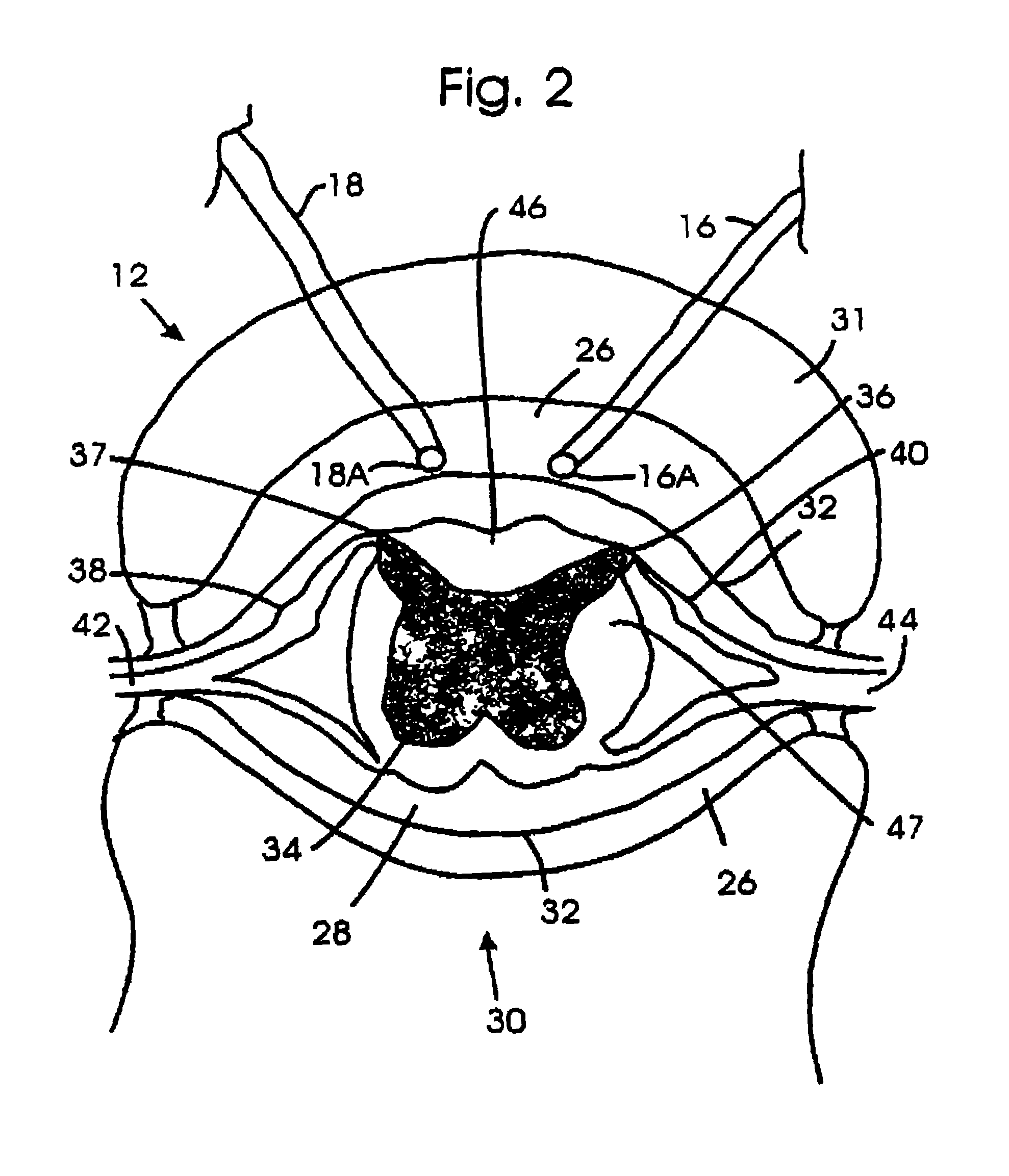 Technique for adjusting the locus of excitation of electrically excitable tissue