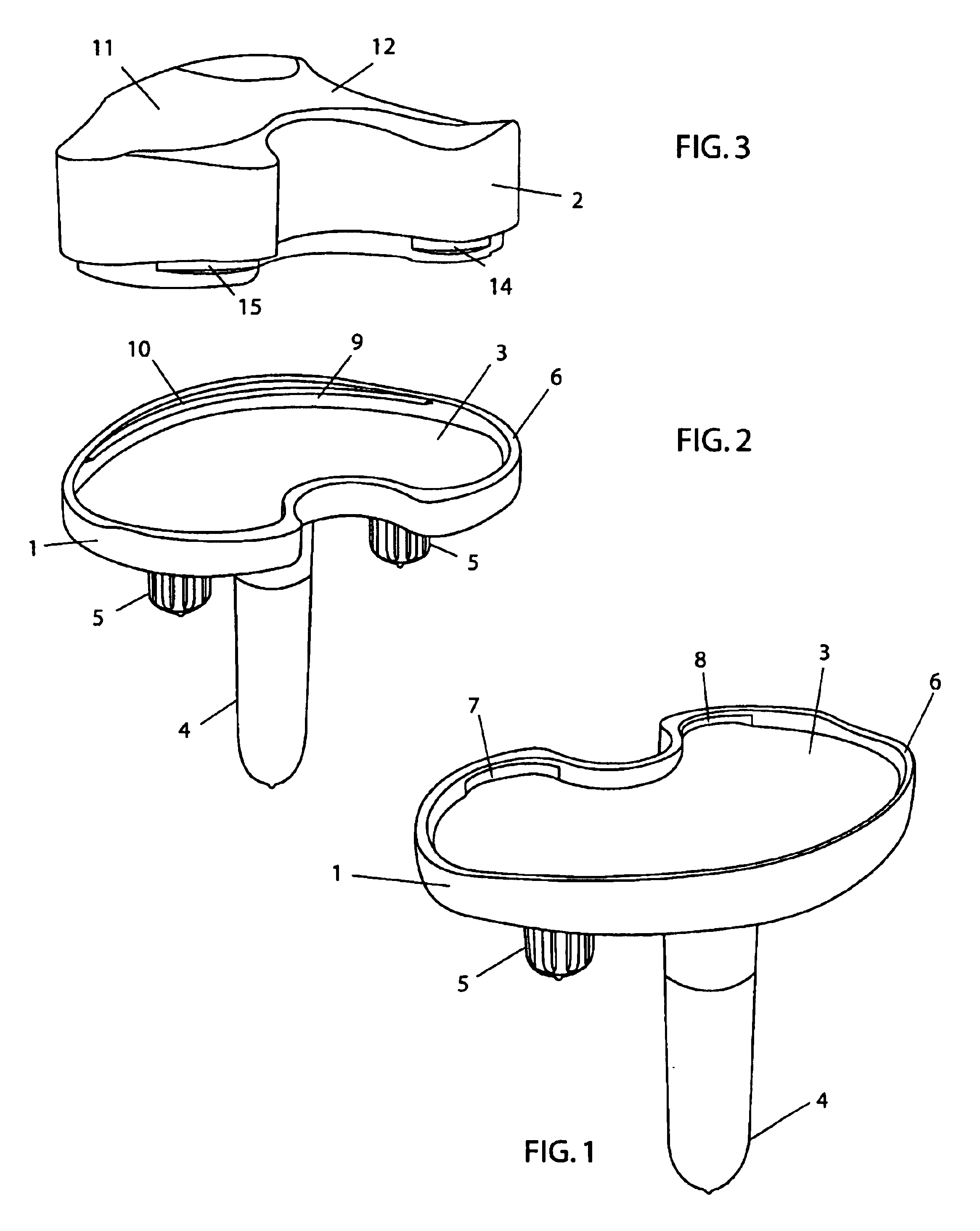 Prosthesis