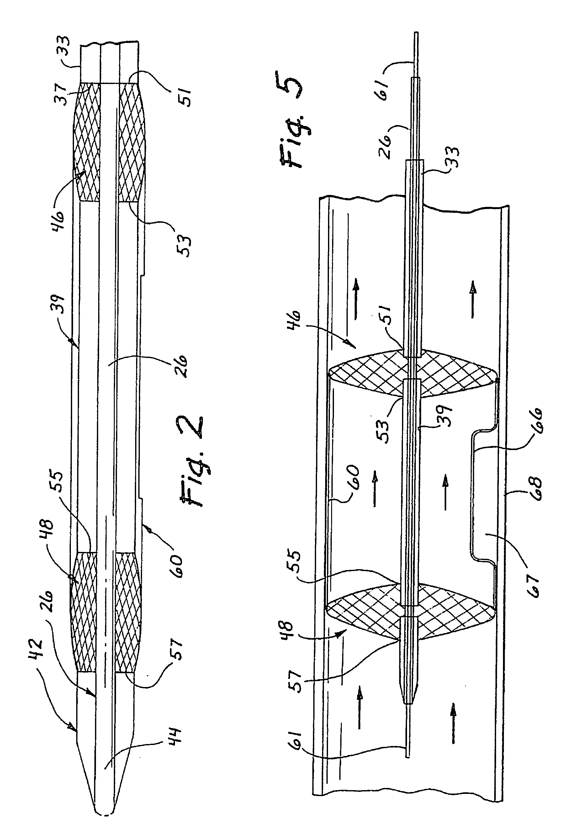 Vascular exclusion catheter