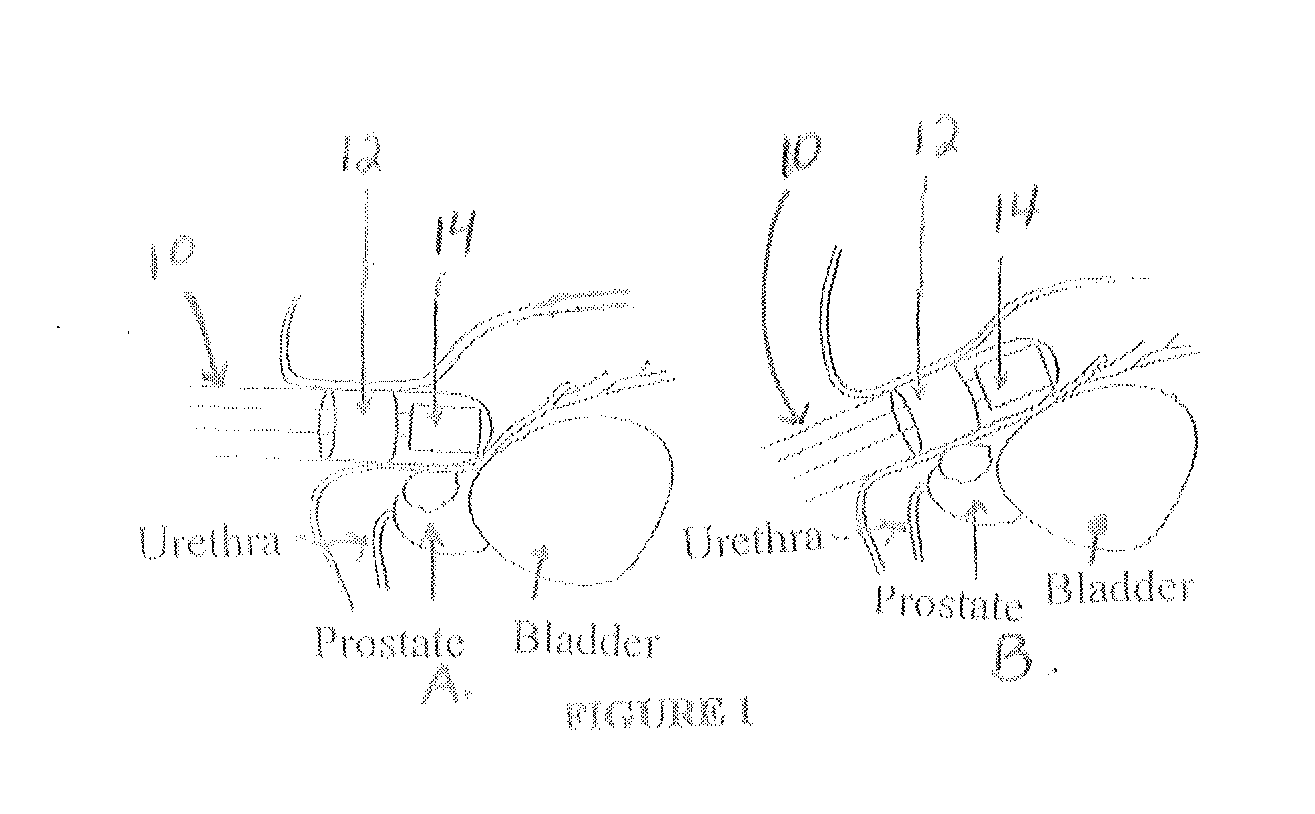 Endorectal Prostate Probe Composed Of A Combined Mini Gamma Camera And Ultrasound Sensor