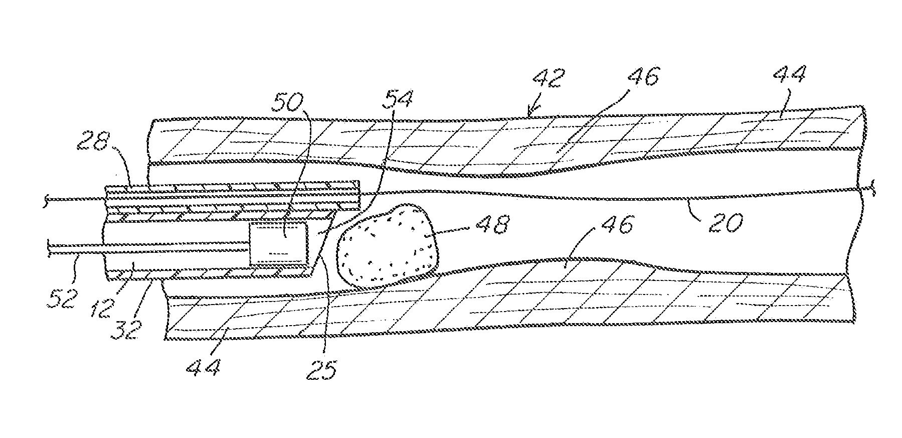 Aspiration Catheter Having Variable Volume Distal Suction Chamber