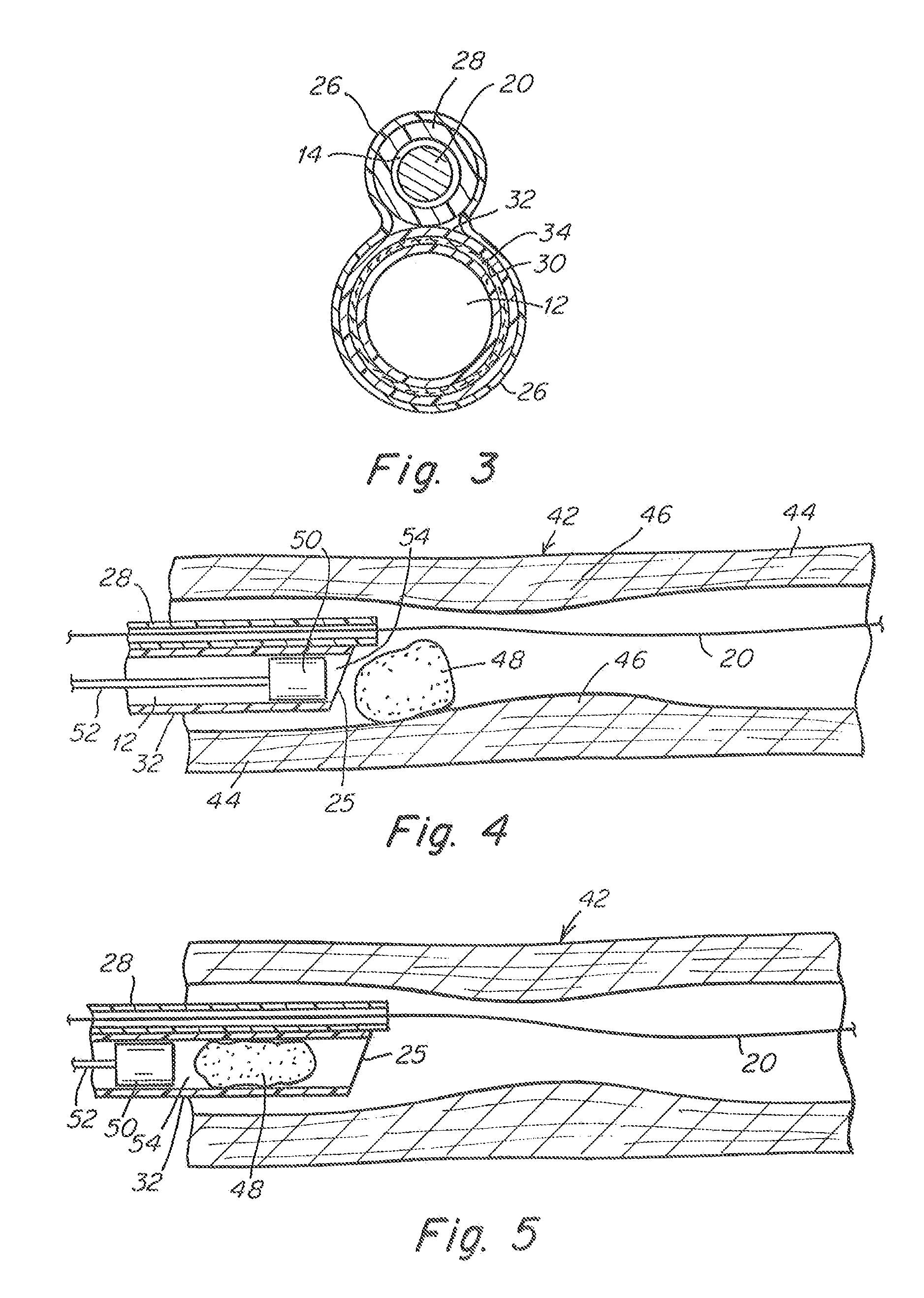 Aspiration Catheter Having Variable Volume Distal Suction Chamber