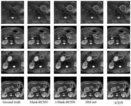 Pancreatic tumor image segmentation method based on dense connection network transfer learning