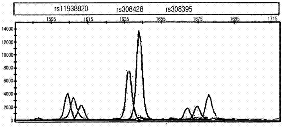 Single nucleotide polymorphism for prognosis of hepatocellular carcinoma