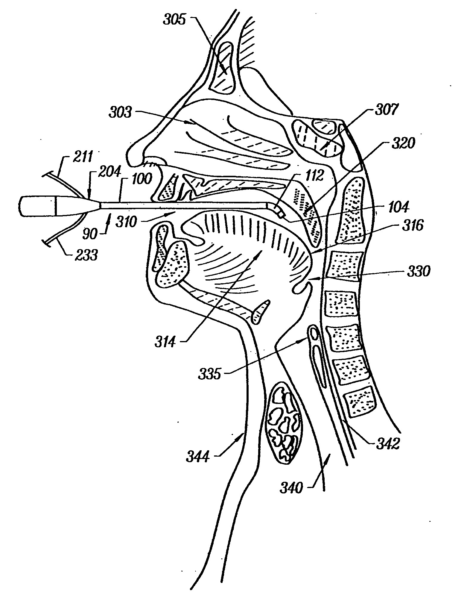 Method for treating obstructive sleep disorder includes removing tissue from base of tongue