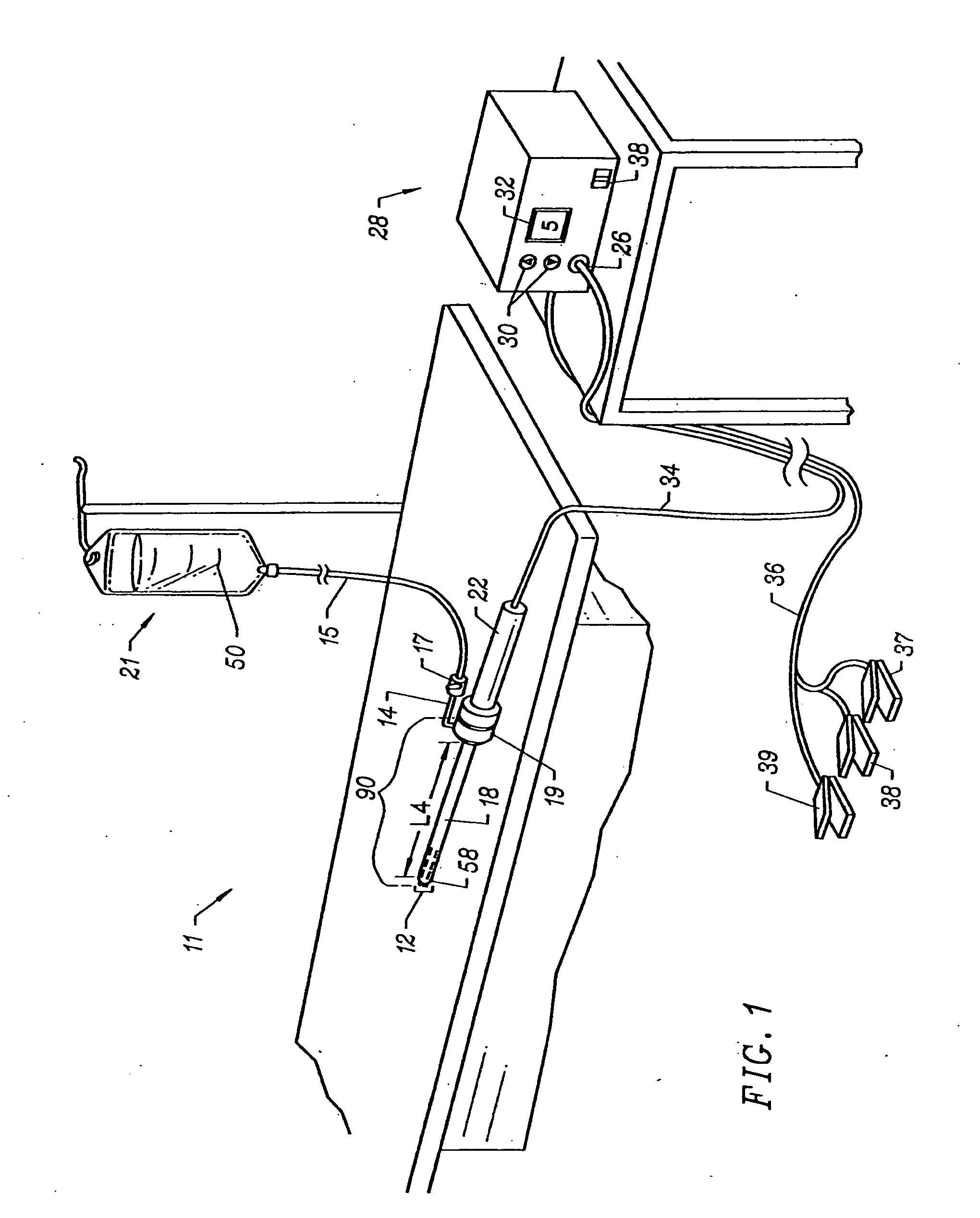 Method for treating obstructive sleep disorder includes removing tissue from base of tongue