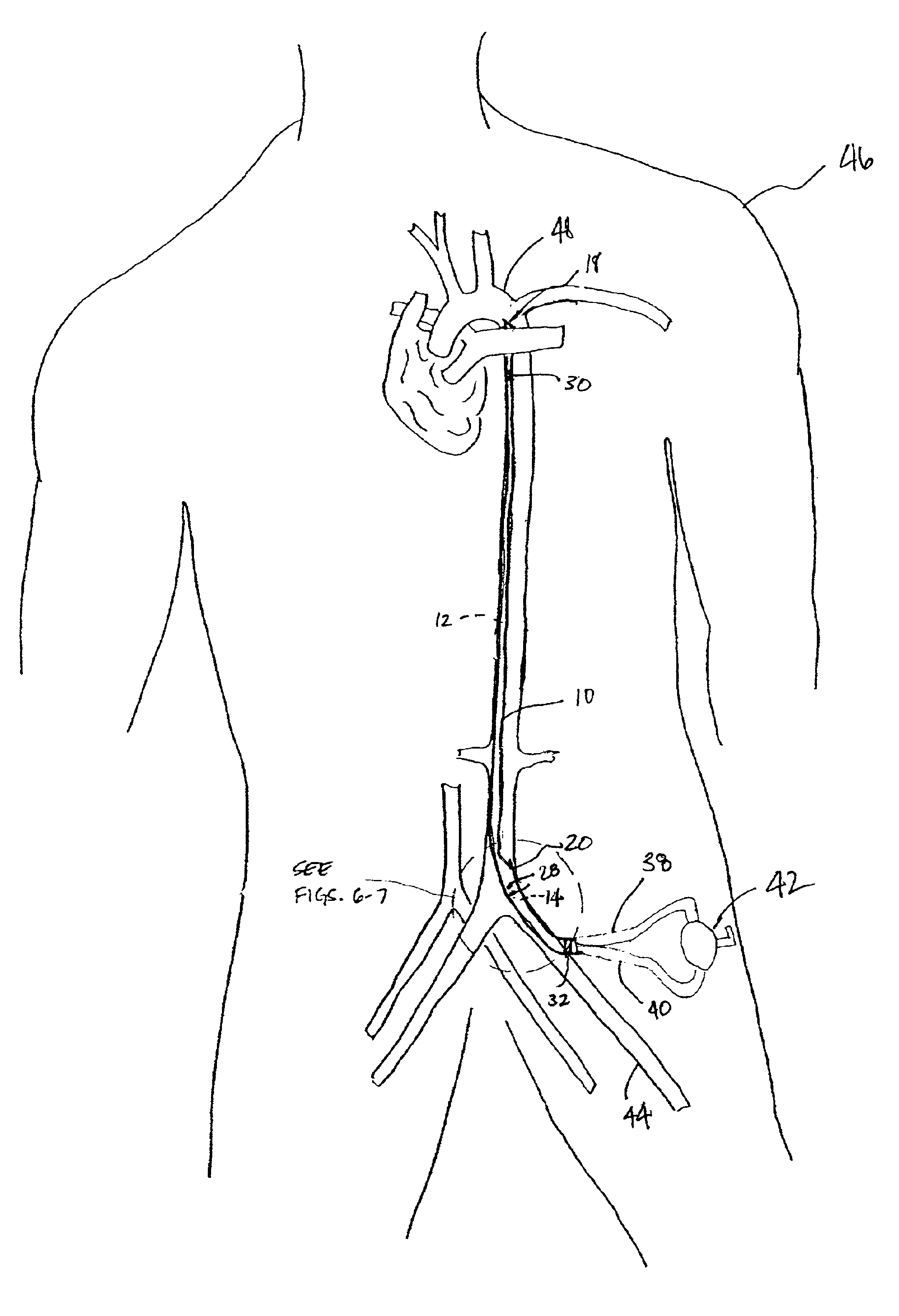 Multilumen catheter for minimizing limb ischemia