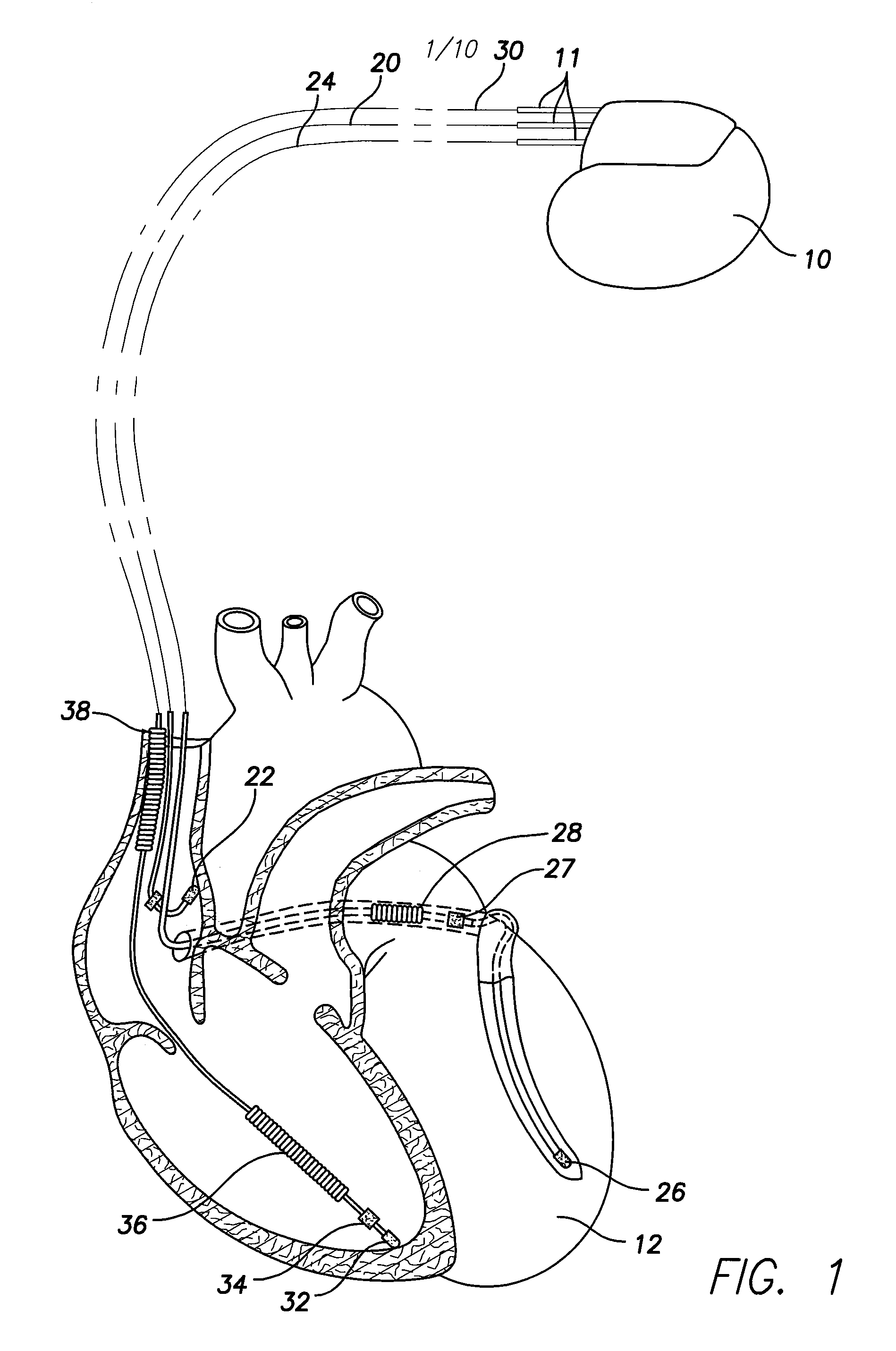 Capacitor-integrated feedthrough assembly with improved grounding for an implantable medical device