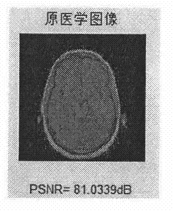 Medical image robust watermarking method based on Arnold scrambling transformation and DCT (discrete cosine transformation)