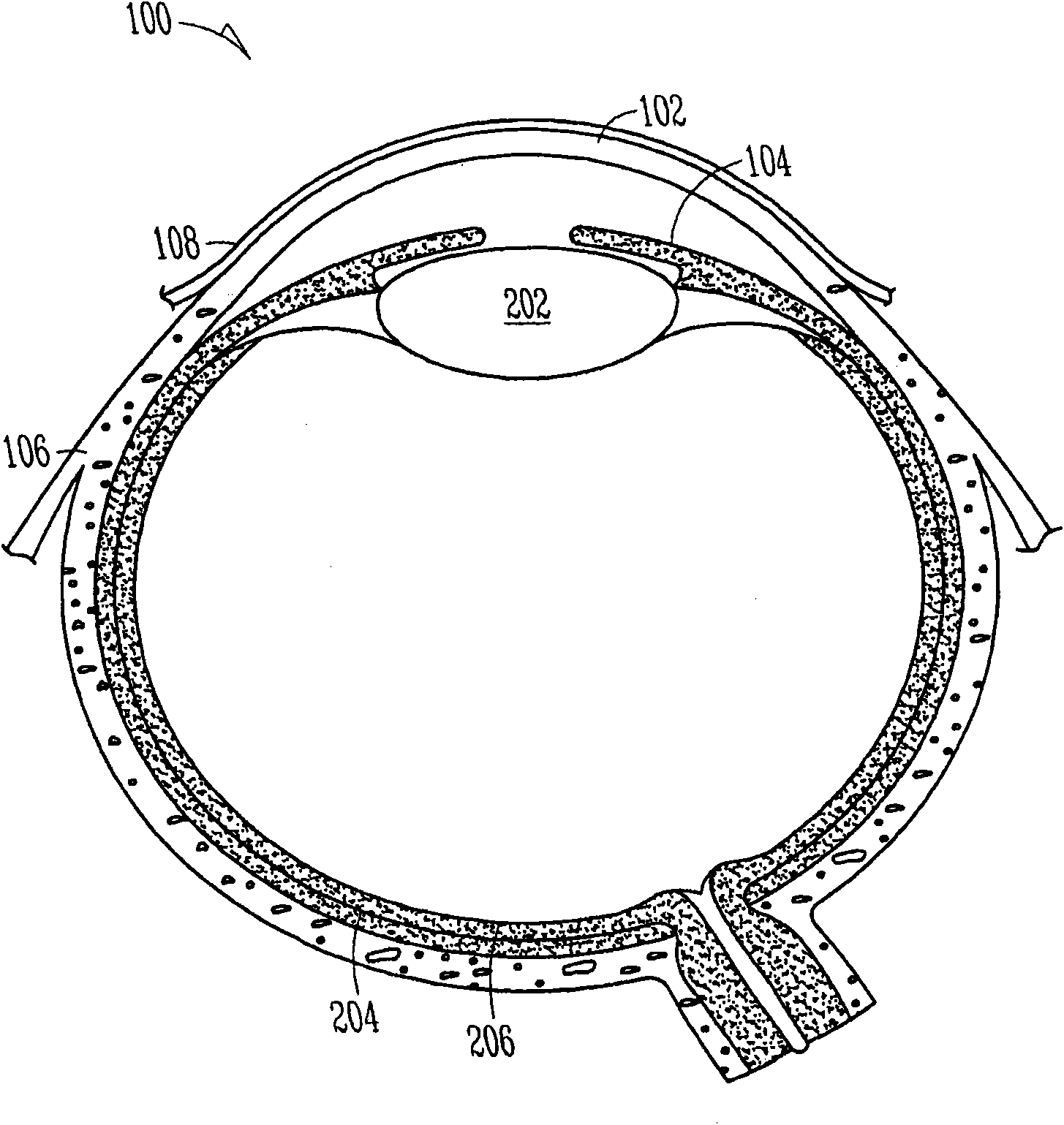 Lacrimal implants and related methods