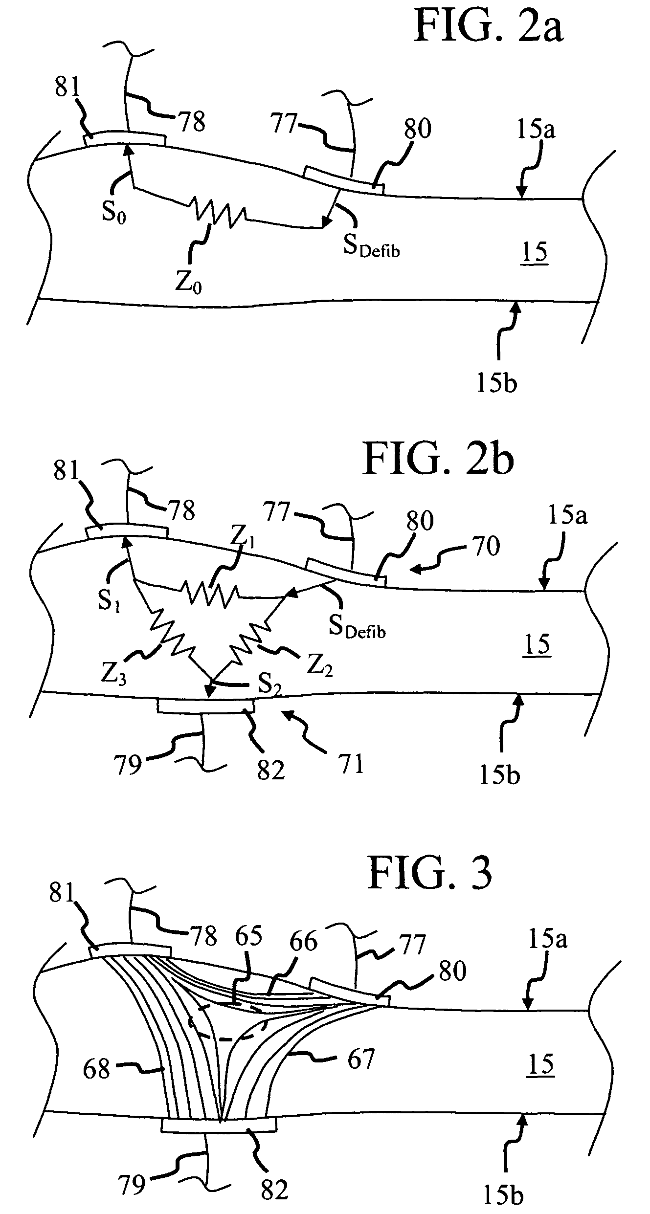 Electrode system for a physiological stimulator