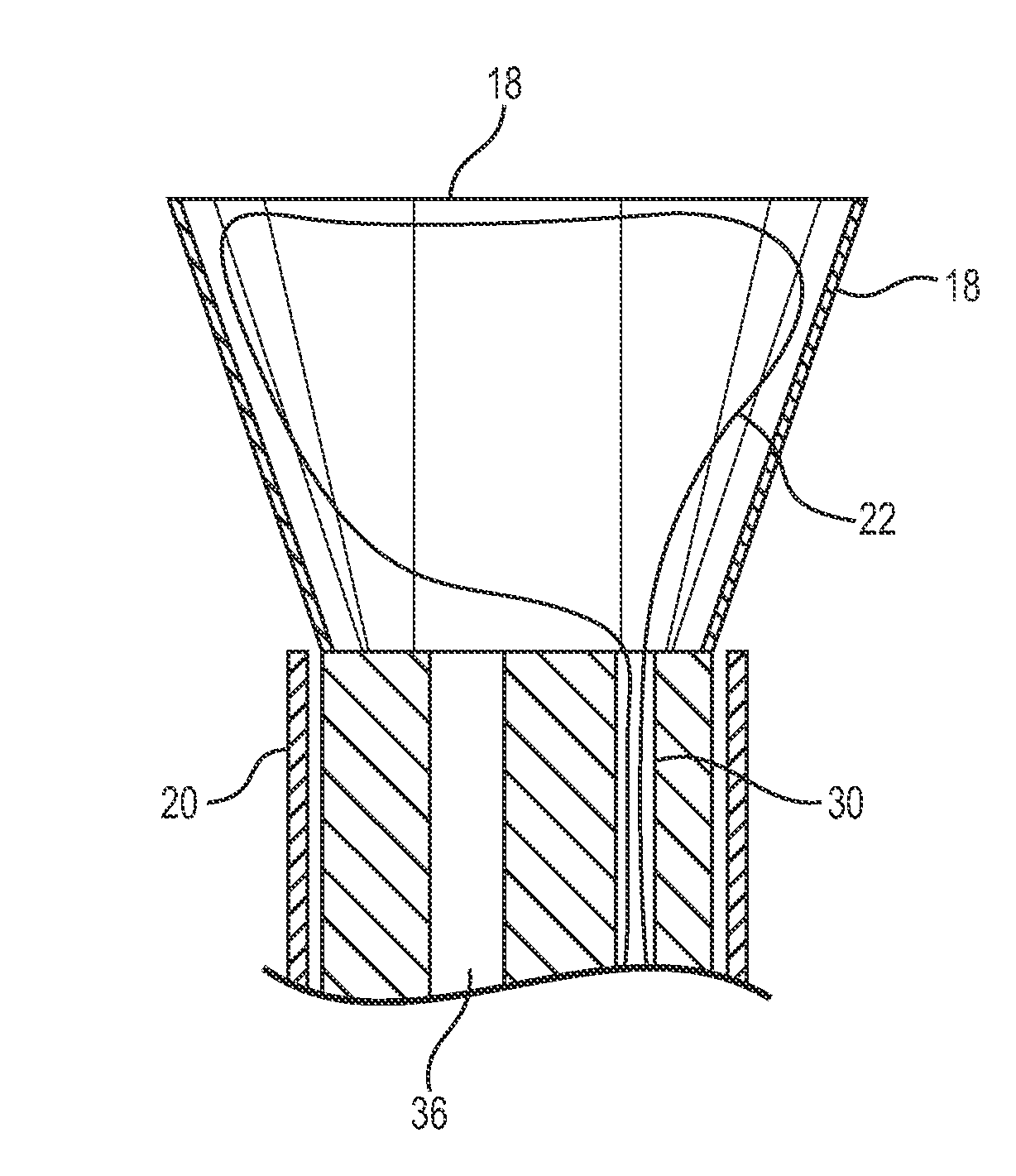 Necrosectomy assist device