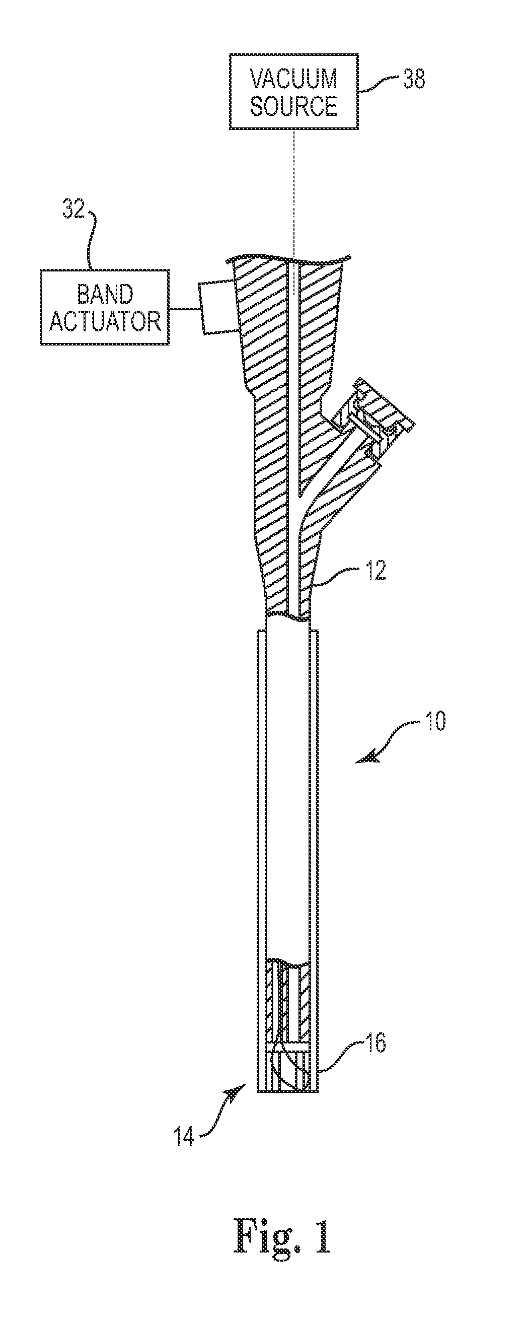 Necrosectomy assist device